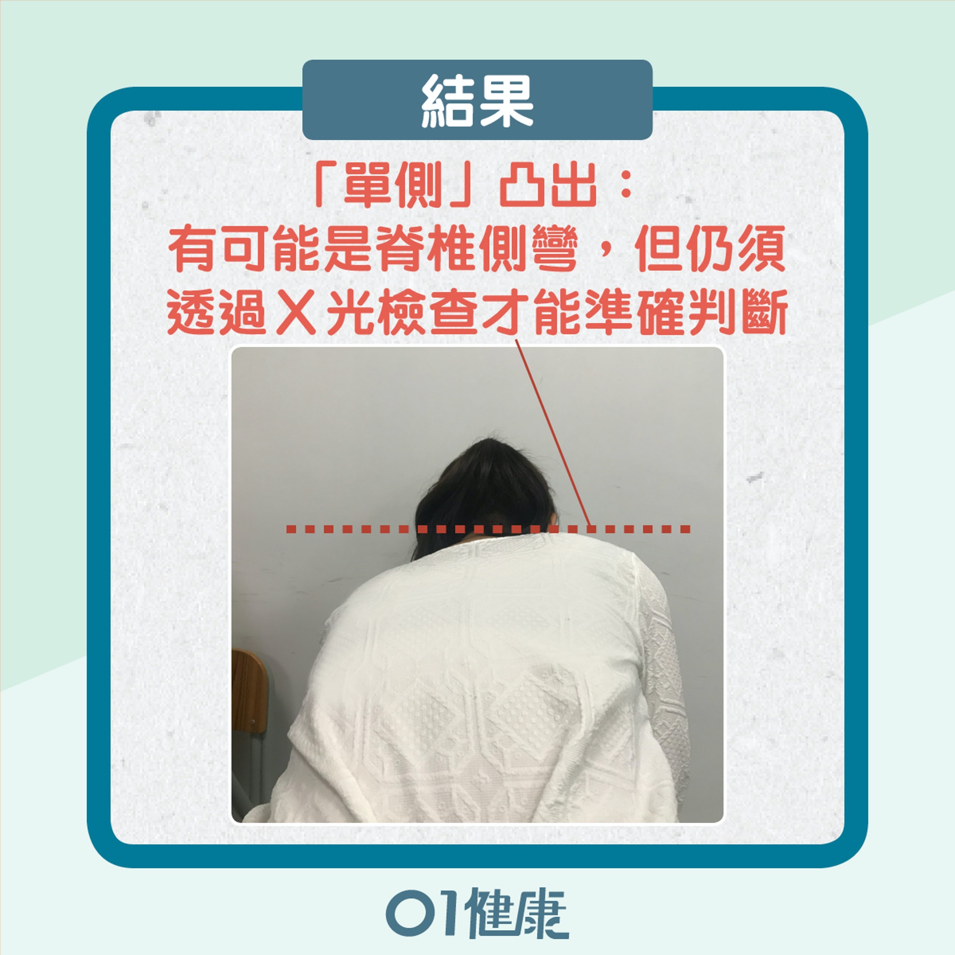 自我檢測脊椎側彎(01製圖) 自我檢測脊椎側彎(01製圖)