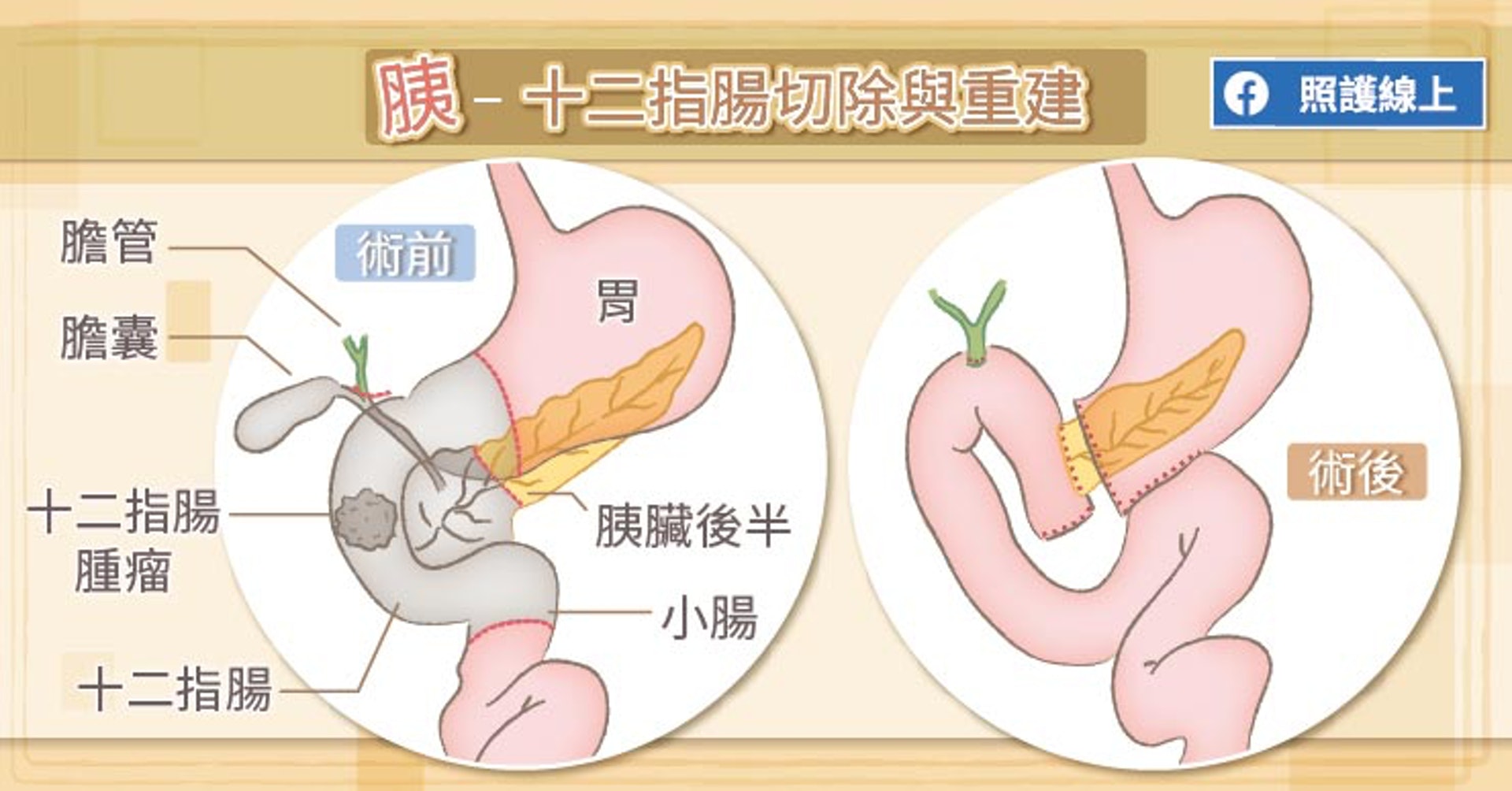 胰–十二指腸切除與重建（照護線上授權使用）