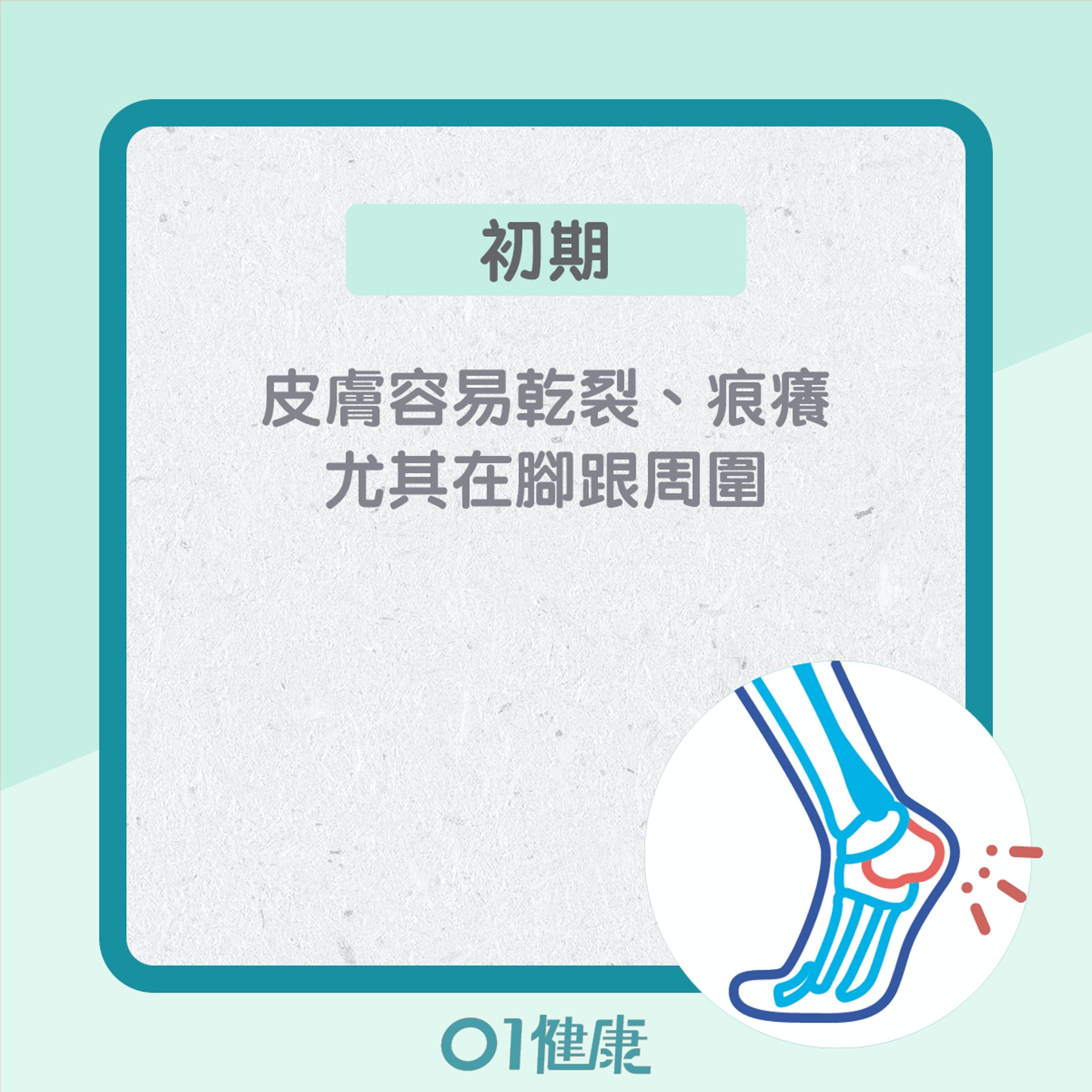 糖尿腳不同的階段的症狀(01製圖) 糖尿腳不同的階段的症狀(01製圖)