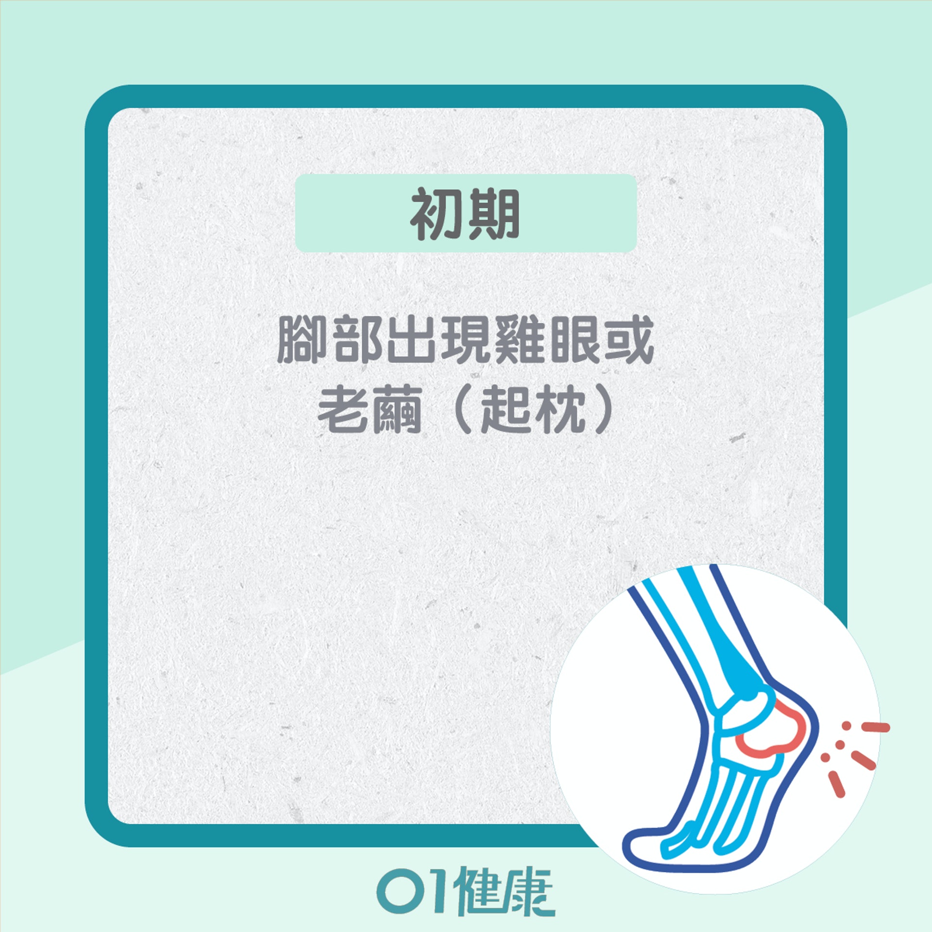 糖尿腳不同的階段的症狀(01製圖) 糖尿腳不同的階段的症狀(01製圖)