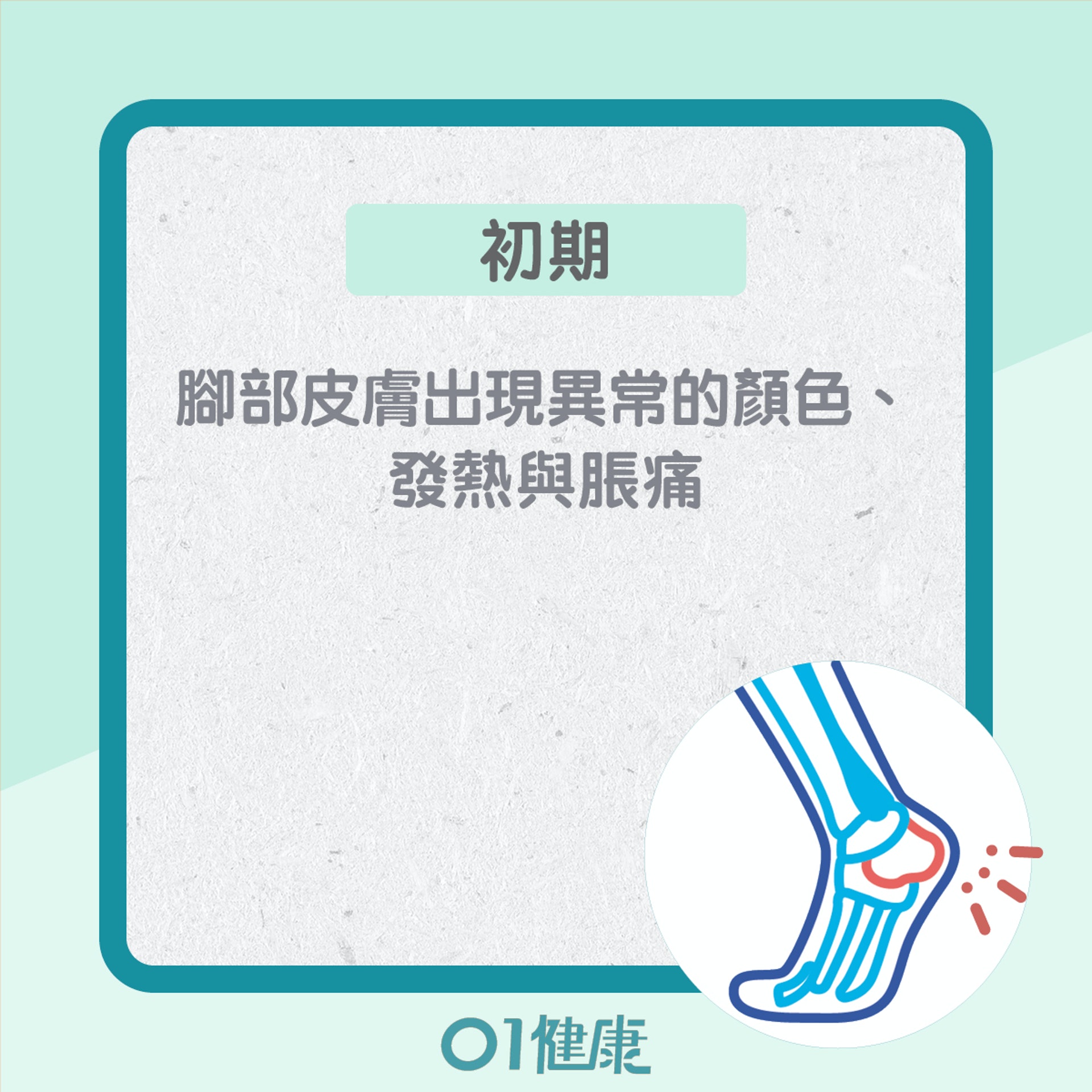 糖尿腳不同的階段的症狀(01製圖) 糖尿腳不同的階段的症狀(01製圖)