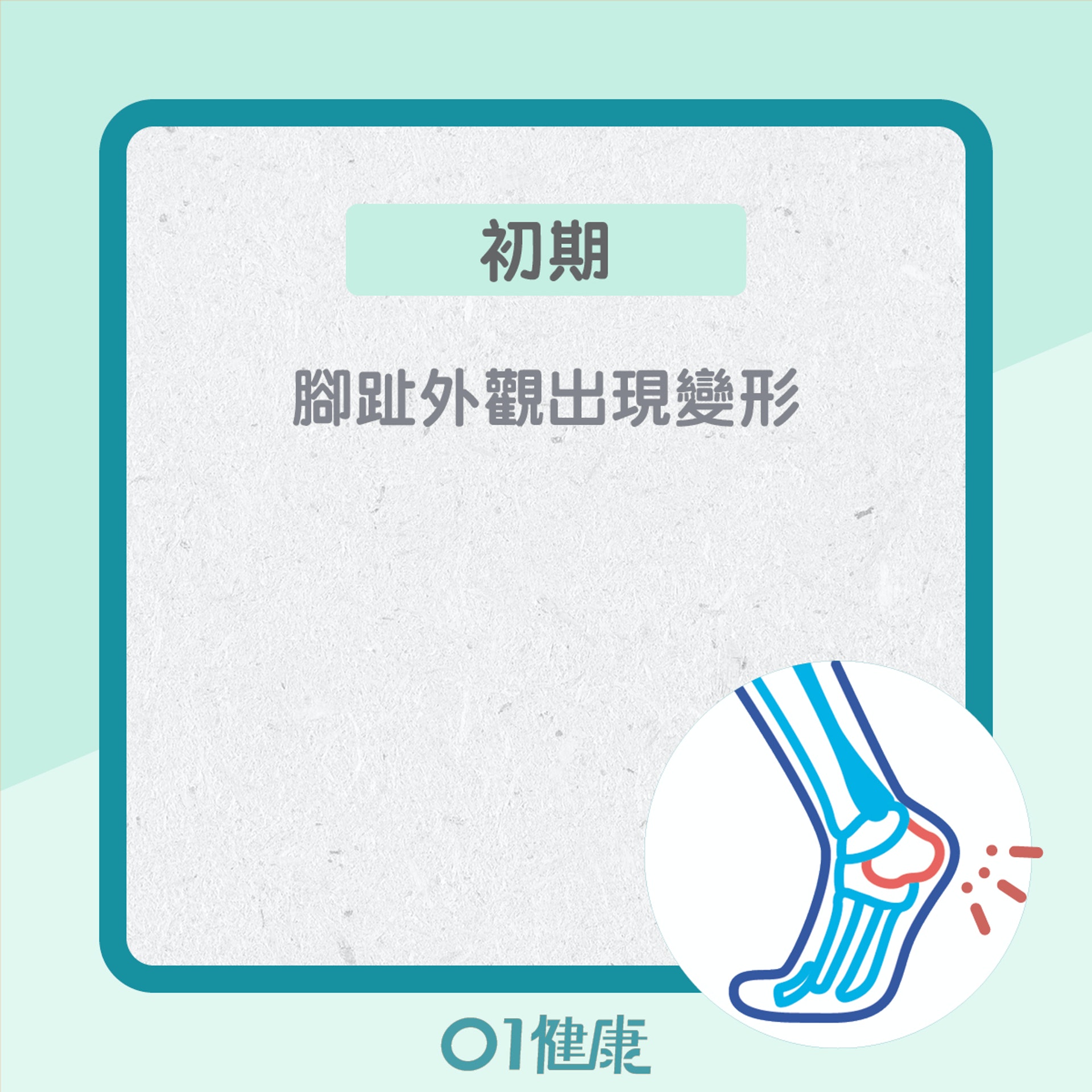 糖尿腳不同的階段的症狀(01製圖) 糖尿腳不同的階段的症狀(01製圖)
