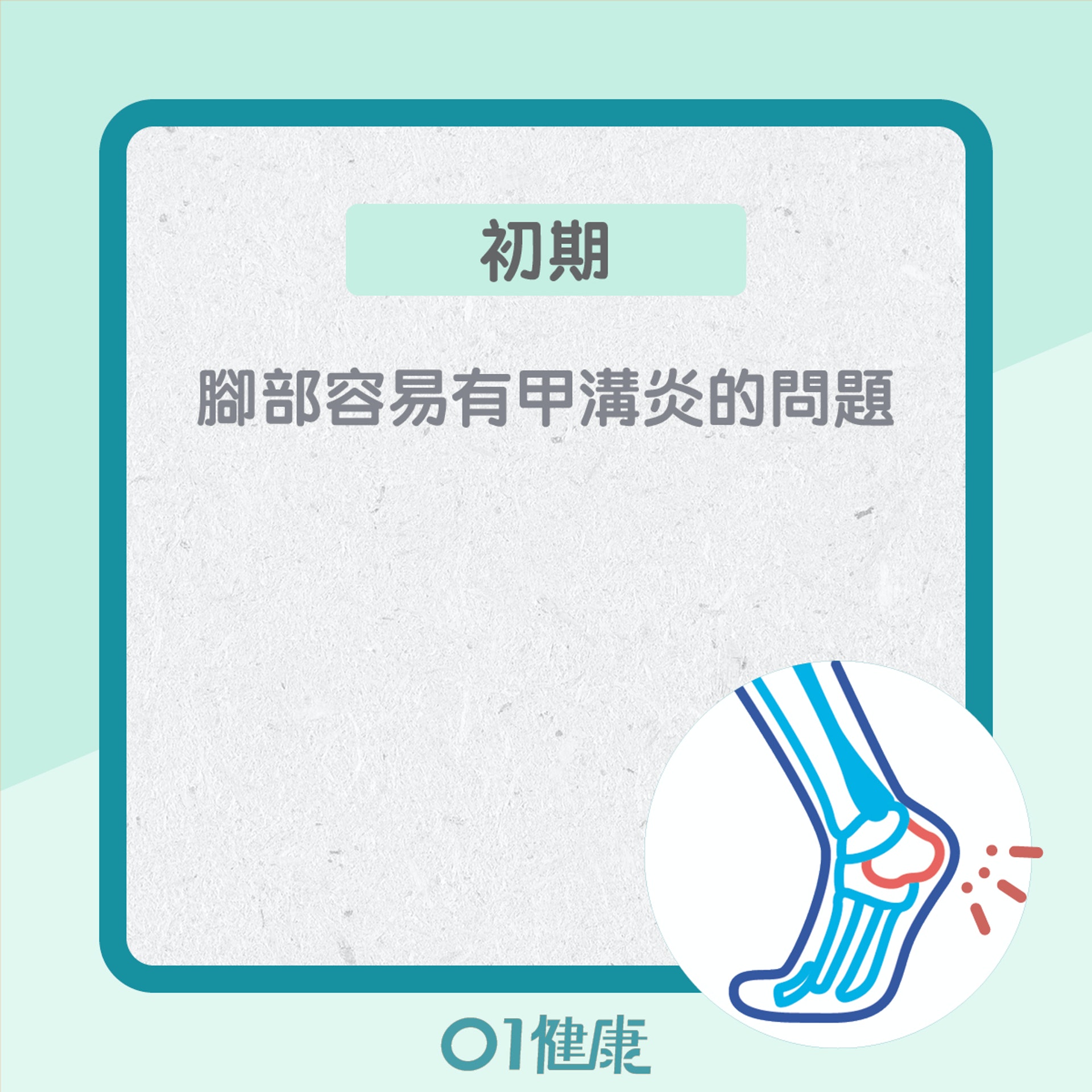 糖尿腳不同的階段的症狀(01製圖) 糖尿腳不同的階段的症狀(01製圖)