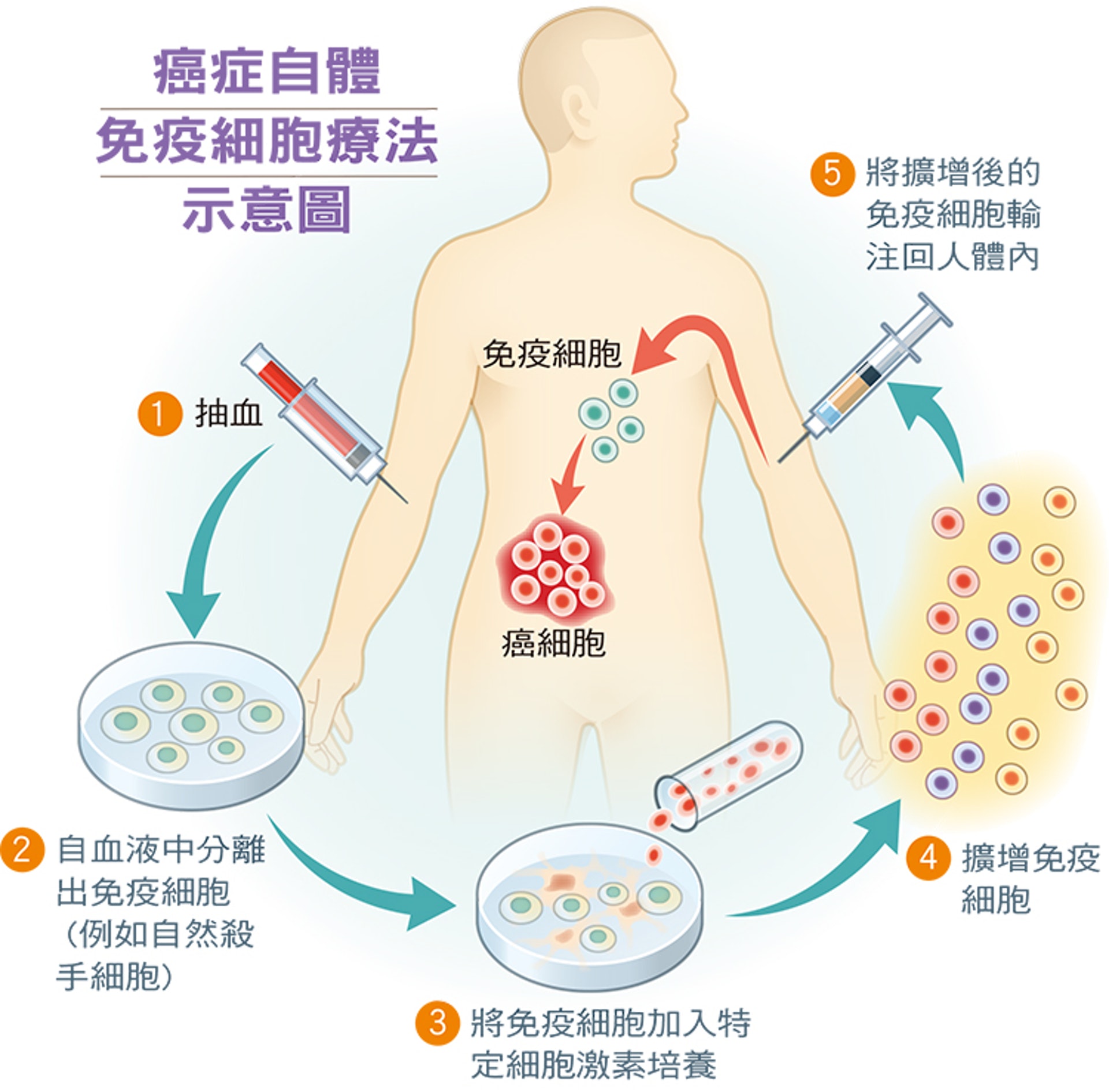 NK免疫治療示意圖(圖片:liver.org) NK免疫治療示意圖(圖片:liver.org)
