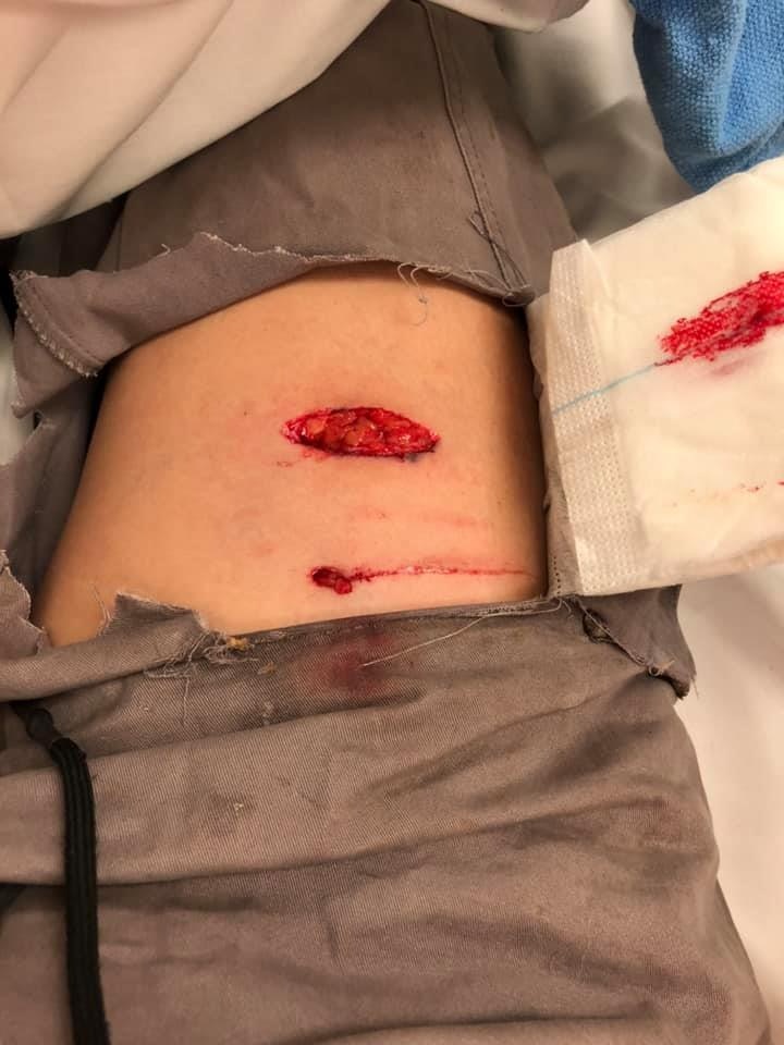 其後前線義工Jinny亦不小心被狗狗咬傷大脾,造成肌肉撕裂,傷口有一吋闊。(Facebook@毛孩守護者) 其後前線義工Jinny亦不小心被狗狗咬傷大脾,造成肌肉撕裂,傷口有一吋闊。(Facebook@毛孩守護者)