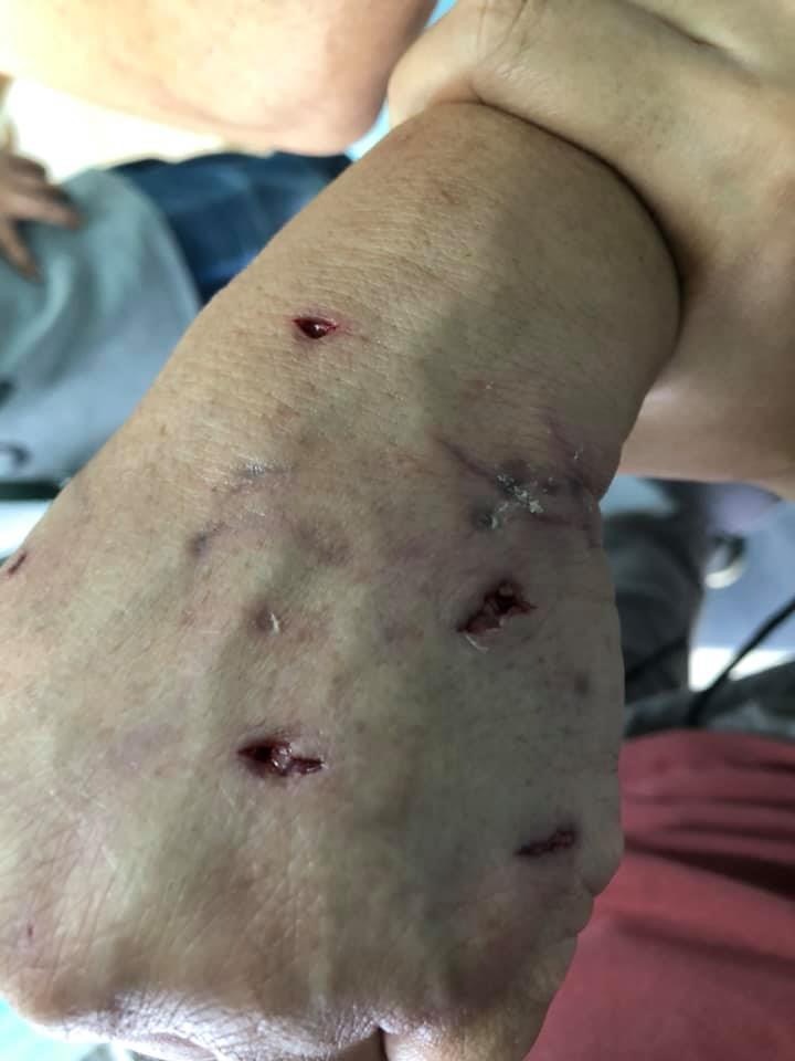 黑仔咬傷Kent的左手,傷及他的筋骨及韌帶。(Facebook@毛孩守護者) 黑仔咬傷Kent的左手,傷及他的筋骨及韌帶。(Facebook@毛孩守護者)