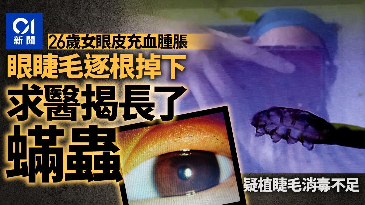 疑因植睫毛消毒不嚴格 浙女真假睫毛掉光 根部還生蠕動蟎蟲 疑因植睫毛消毒不嚴格 浙女真假睫毛掉光 根部還生蠕動蟎蟲