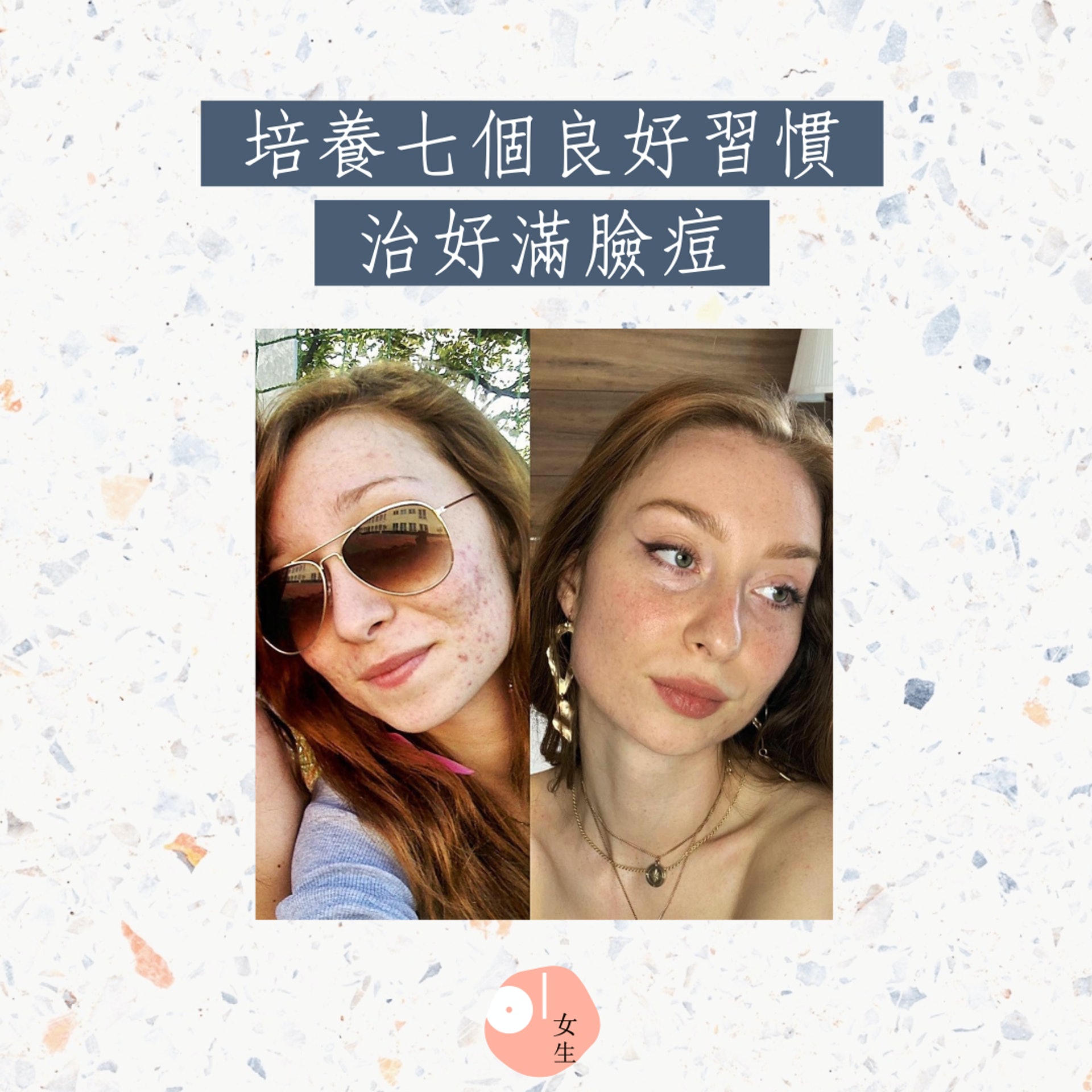 七個治好滿臉痘的好習慣(01製圖/Instagram@muaivanak) 七個治好滿臉痘的好習慣(01製圖/Instagram@muaivanak)
