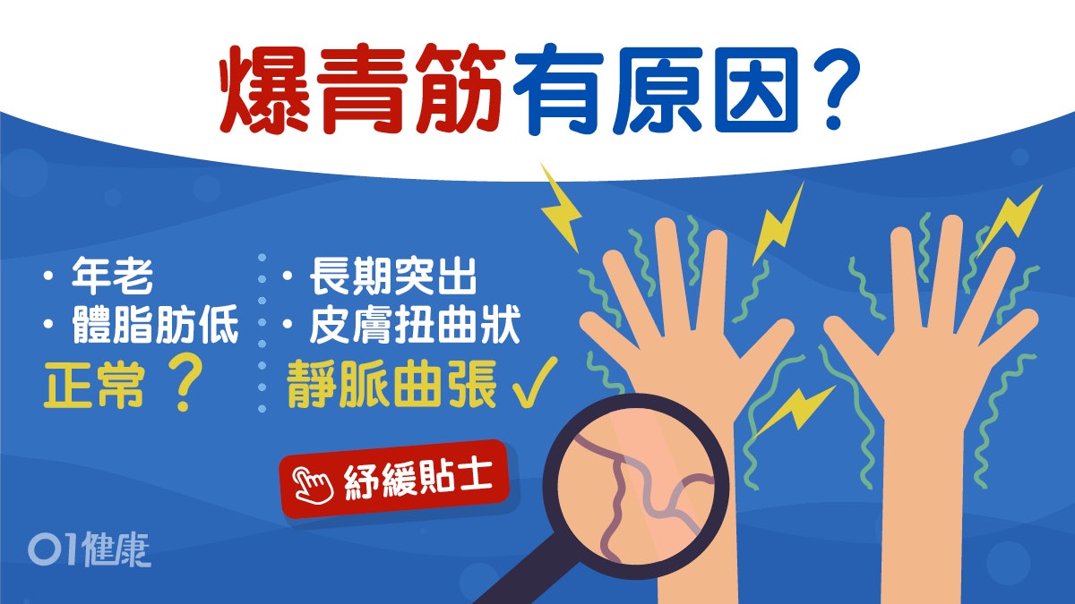 靜脈曲張等於現青筋?皮膚白脂肪少青筋暴現4個可能伴胸痛要小心 靜脈曲張等於現青筋?皮膚白脂肪少青筋暴現4個可能伴胸痛要小心
