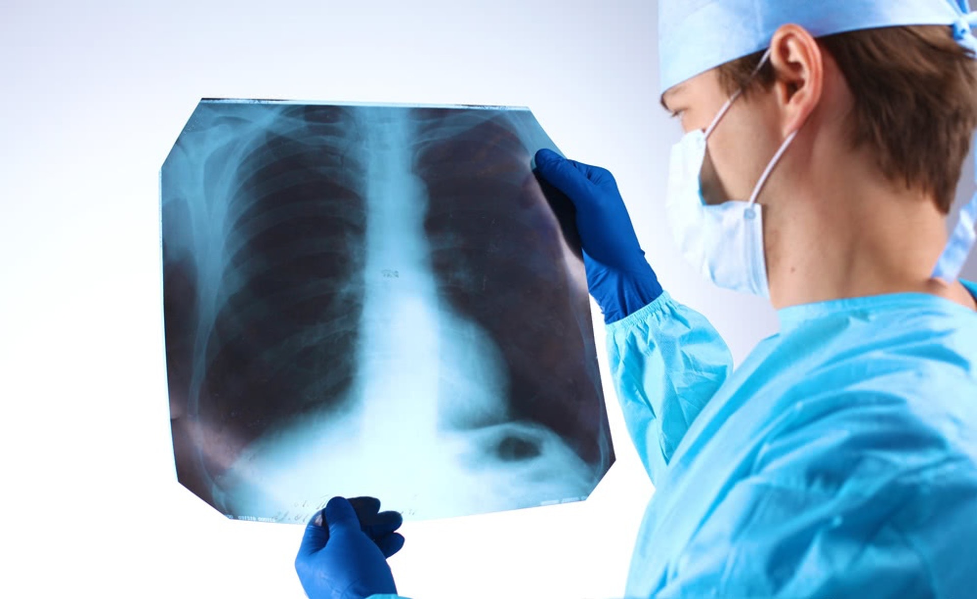 肺部X光片。（圖片：hellorf）