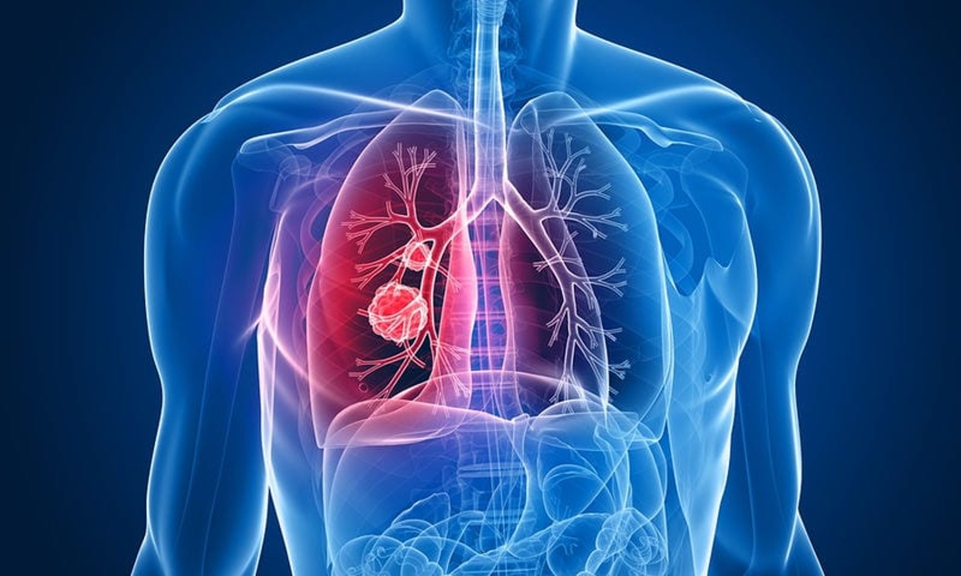 肺癌示意圖（圖片：rodosreport）
