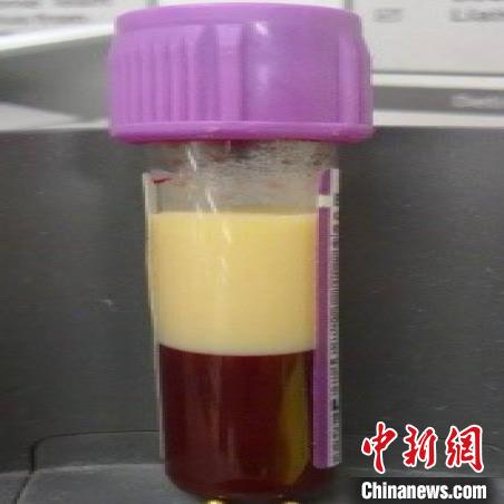 醫護從小強體內抽出的一管血中,竟有一半是「油脂」一樣的液體。(中新網) 醫護從小強體內抽出的一管血中,竟有一半是「油脂」一樣的液體。(中新網)