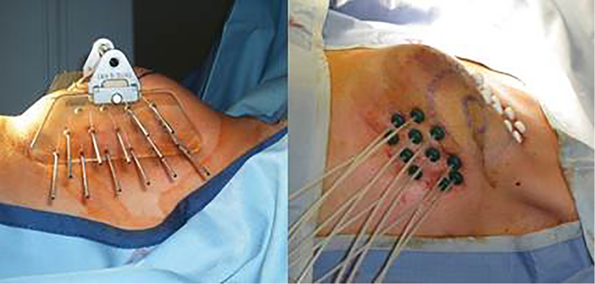 多導管乳房近距離治療加速部分乳房照射 (Interstitial multi-catheter breast brachytherapy as Accelerated Partial Breast Irradiation)—GEC ESTRO 研究。(圖片由張天怡醫生提供。) 多導管乳房近距離治療加速部分乳房照射 (Interstitial multi-catheter breast brachytherapy as Accelerated Partial Breast Irradiation)—GEC ESTRO 研究。(圖片由張天怡醫生提供。)