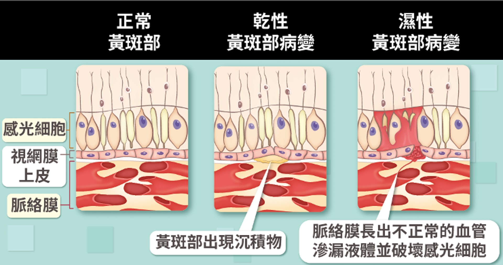 黃斑部病變(照護線上授權使用) 黃斑部病變(照護線上授權使用)