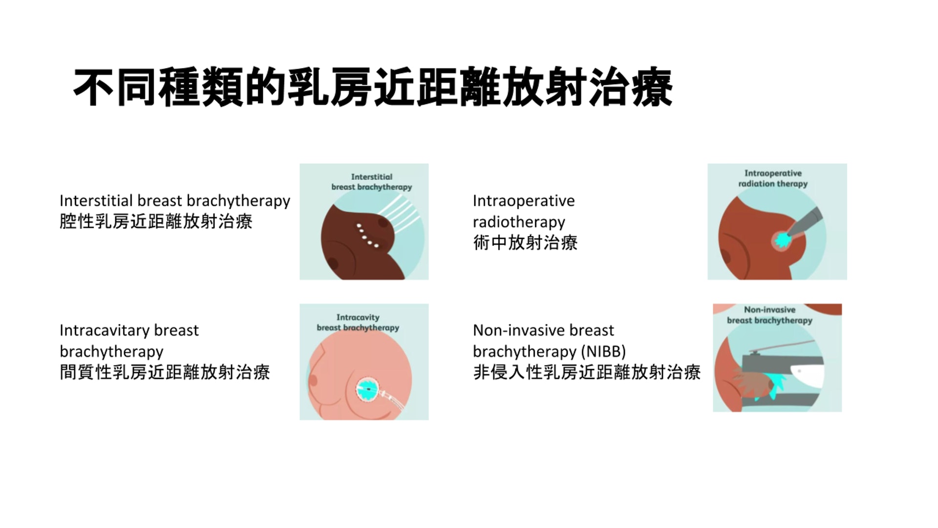不同種類的乳房近距離治療。(圖片由張天怡醫生提供。) 不同種類的乳房近距離治療。(圖片由張天怡醫生提供。)