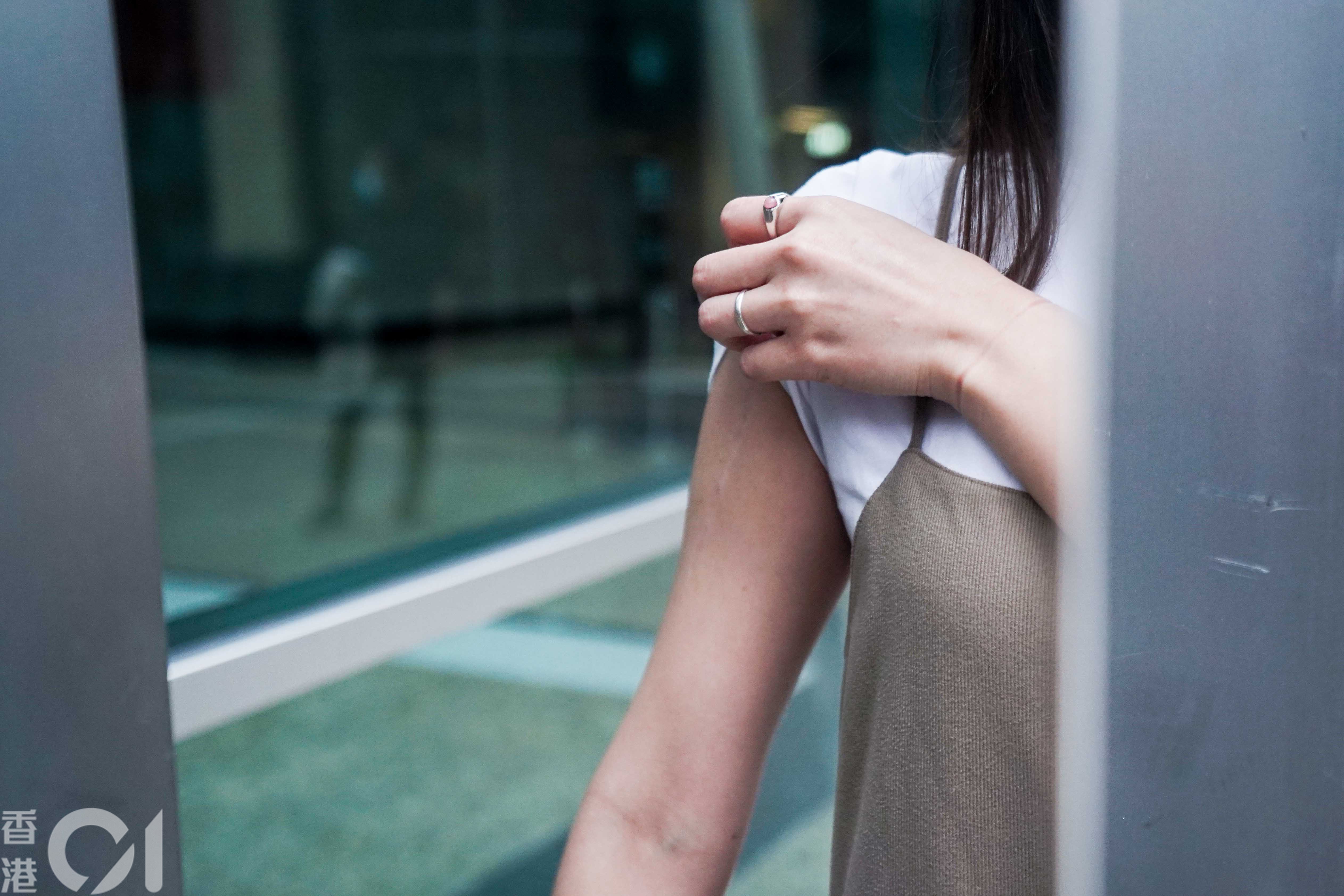 林芷煖直言自己從不忌諱穿背心、泳衣，因為這疤痕沒有不好看。（張倩儀攝）