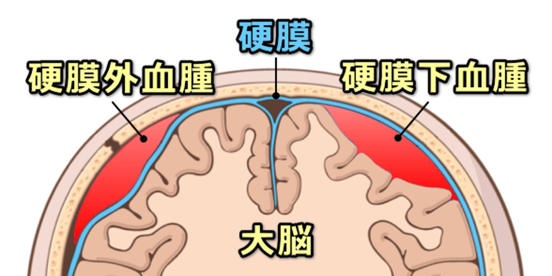 腦硬膜外出血及腦硬膜下出血的分別。（圖片：kenkowalker）