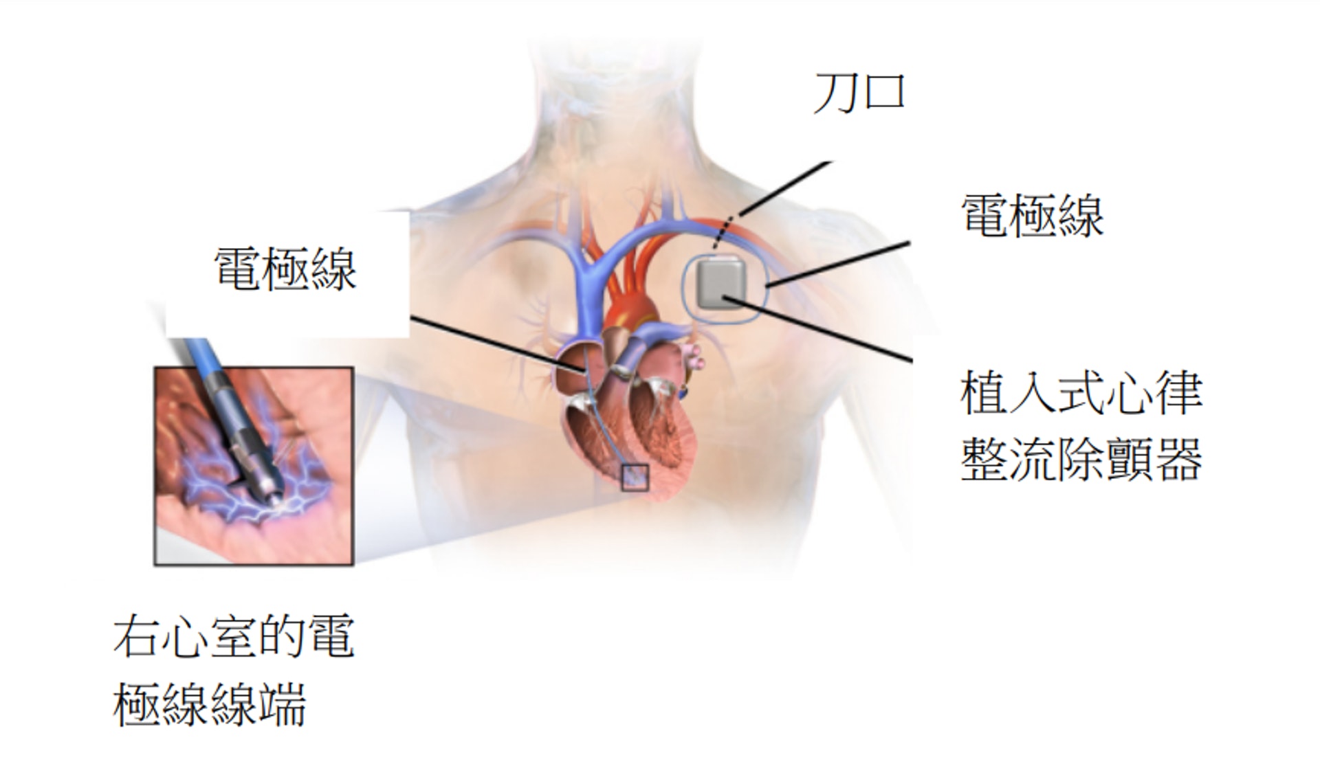 （圖片：cardiacbc）