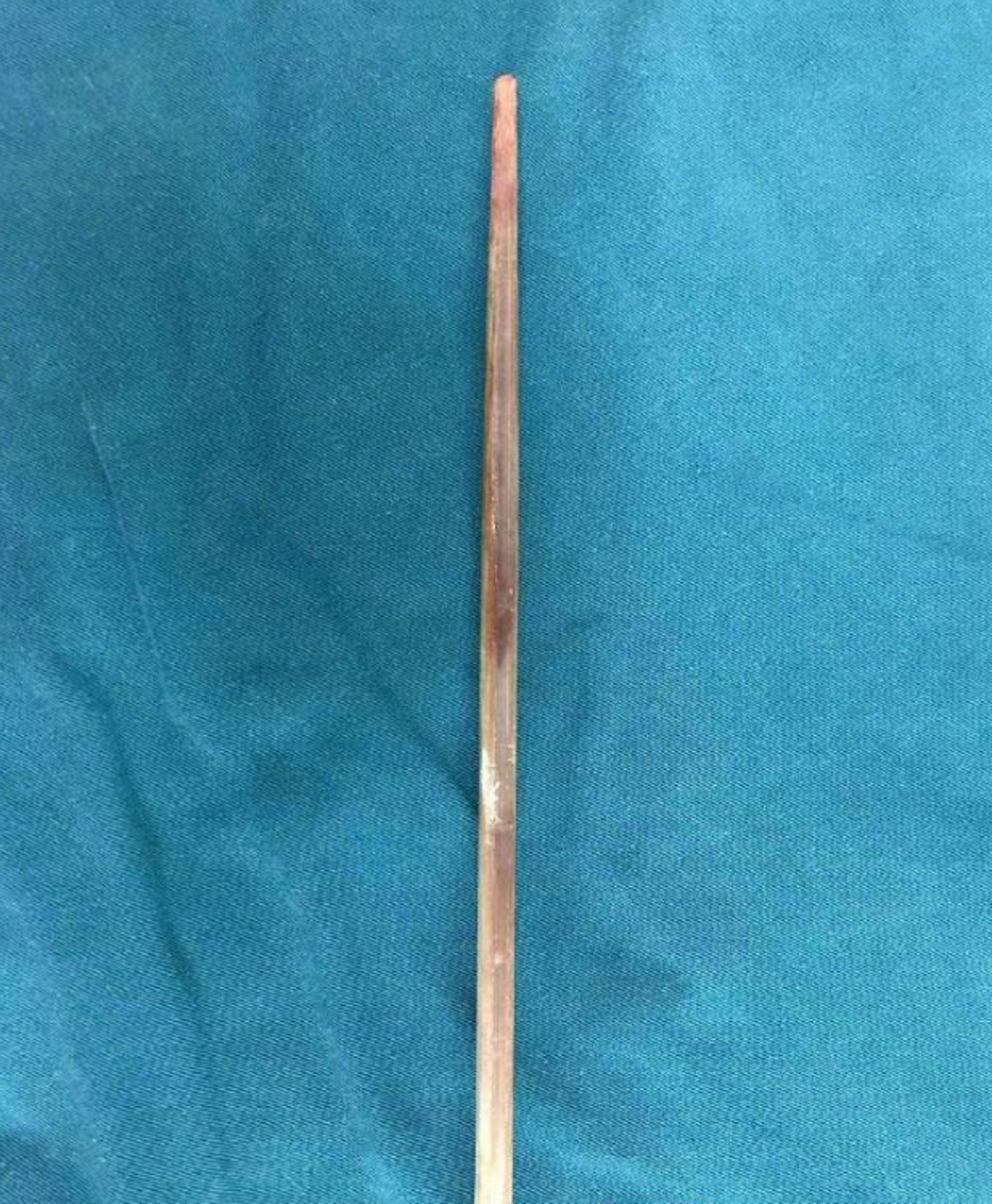 插進林林喉嚨的筷子足足有20厘米長，幸沒傷及食道和氣管。