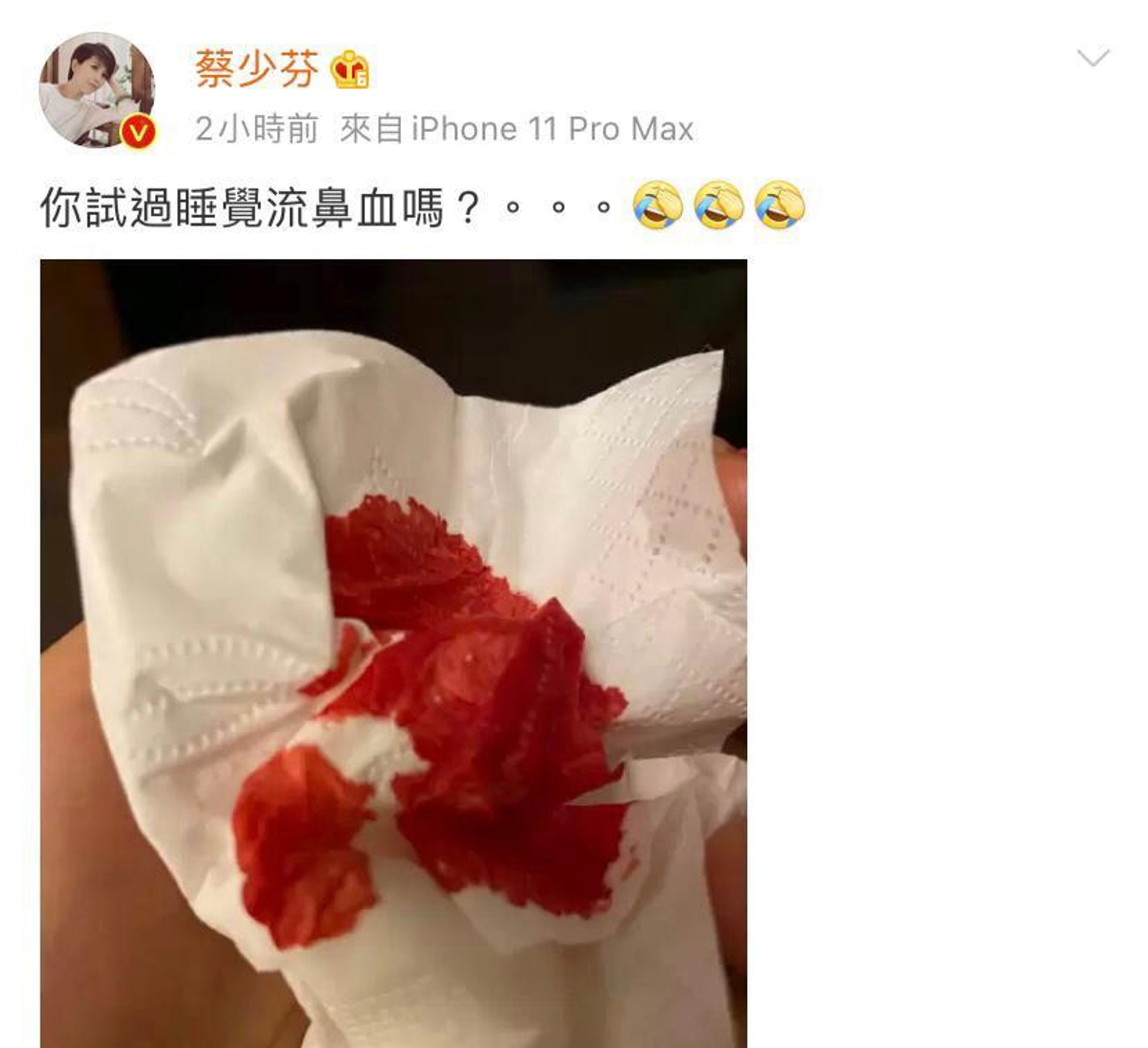 流鼻血 蔡少芬睡覺流鼻血 或因過勞肺燥預防2湯水加搽凡士林 流鼻血 蔡少芬睡覺流鼻血 或因過勞肺燥預防2湯水加搽凡士林