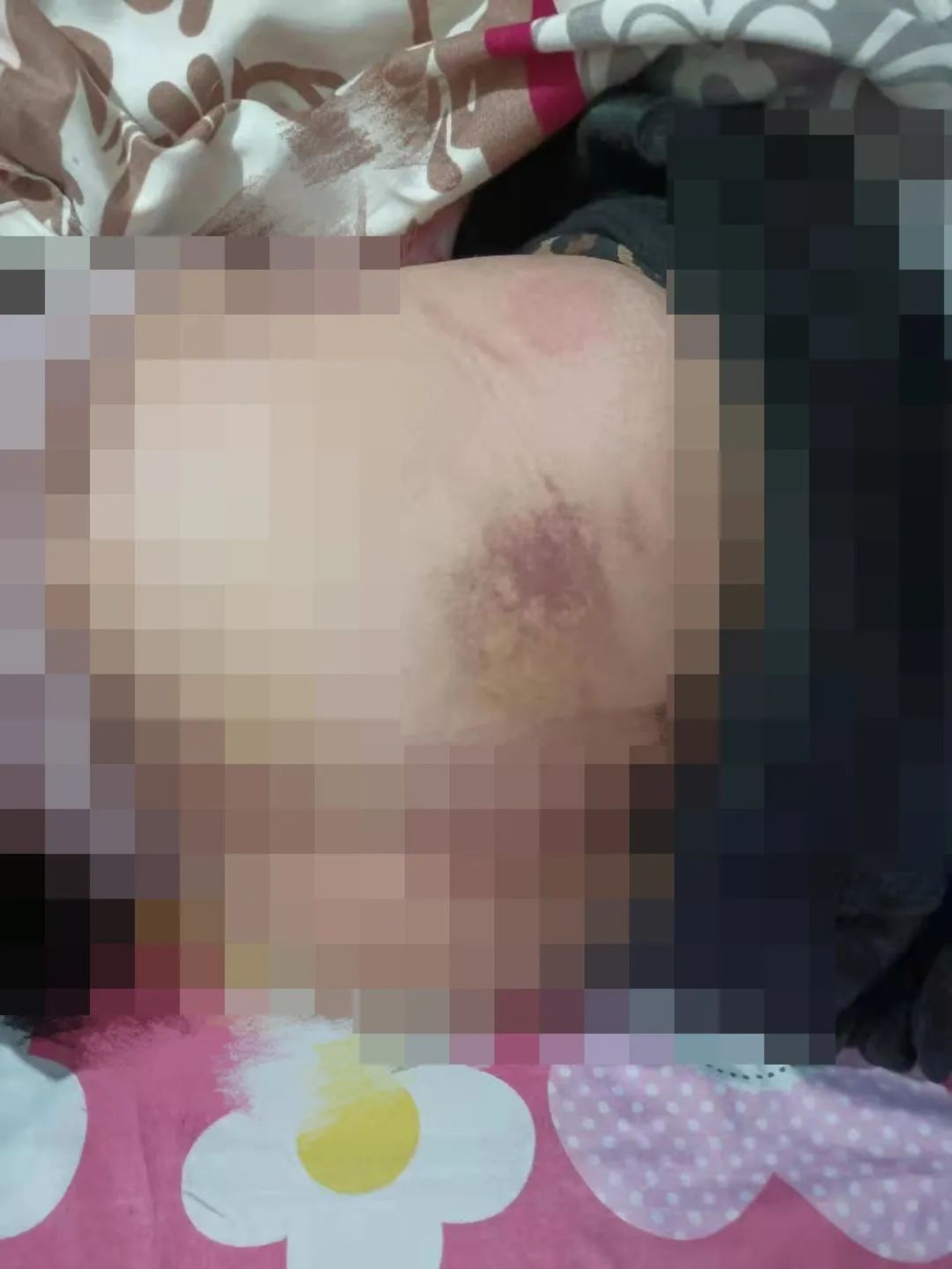 小娟(化名)被校長毆打後,身體多處外傷。(網上圖片) 小娟(化名)被校長毆打後,身體多處外傷。(網上圖片)