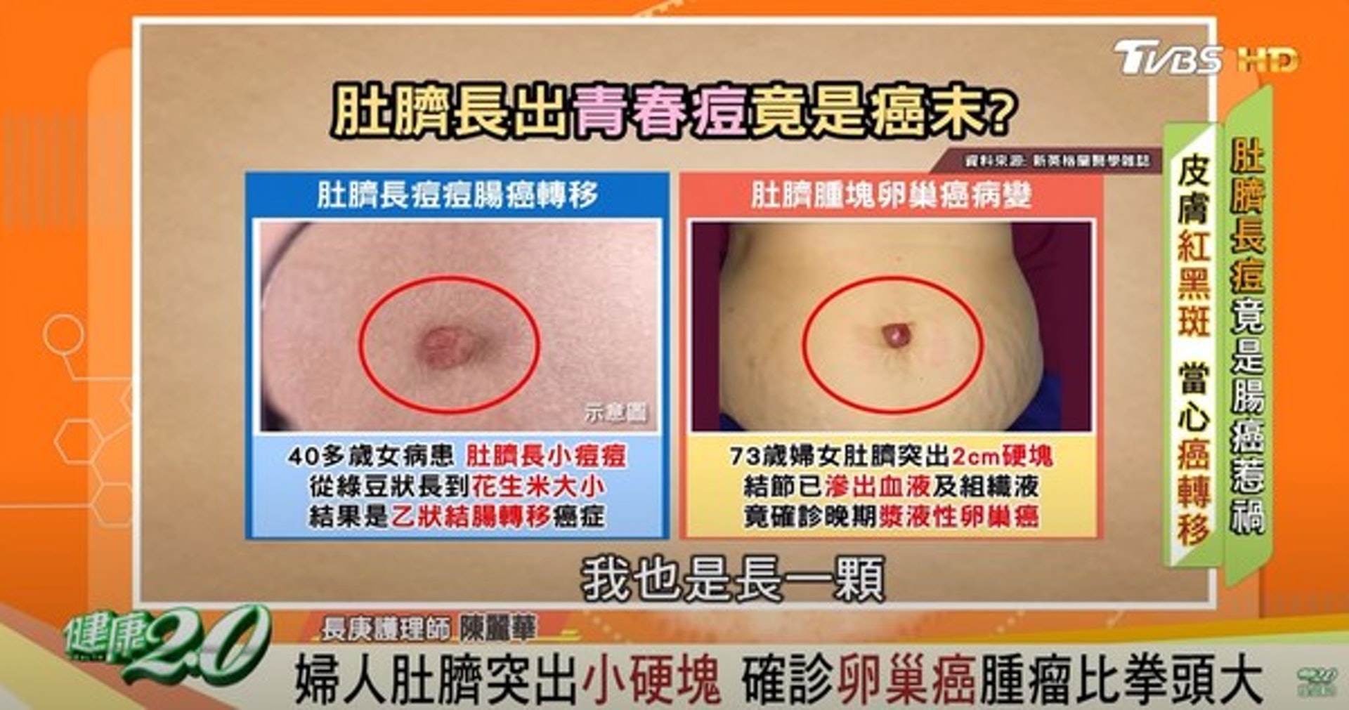 台灣醫師表示，長在腹腔內的腫瘤可能會產生小硬塊在肚臍眼。（YouTube@健康2.0影片截圖）
