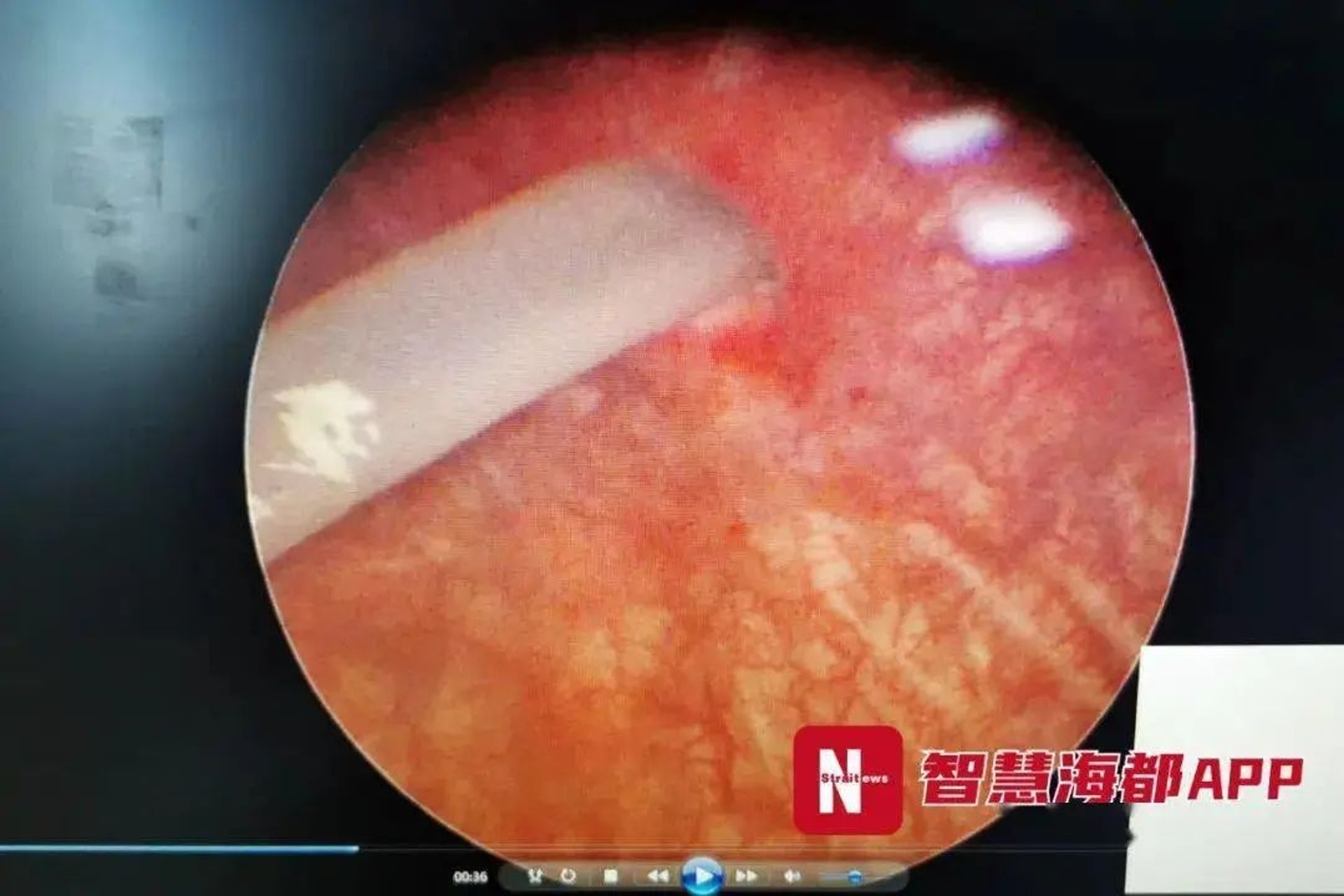 慎入 福建女自慰時 插錯窿 近10厘米膠棒尿道直入刺穿膀胱 慎入 福建女自慰時 插錯窿 近10厘米膠棒尿道直入刺穿膀胱