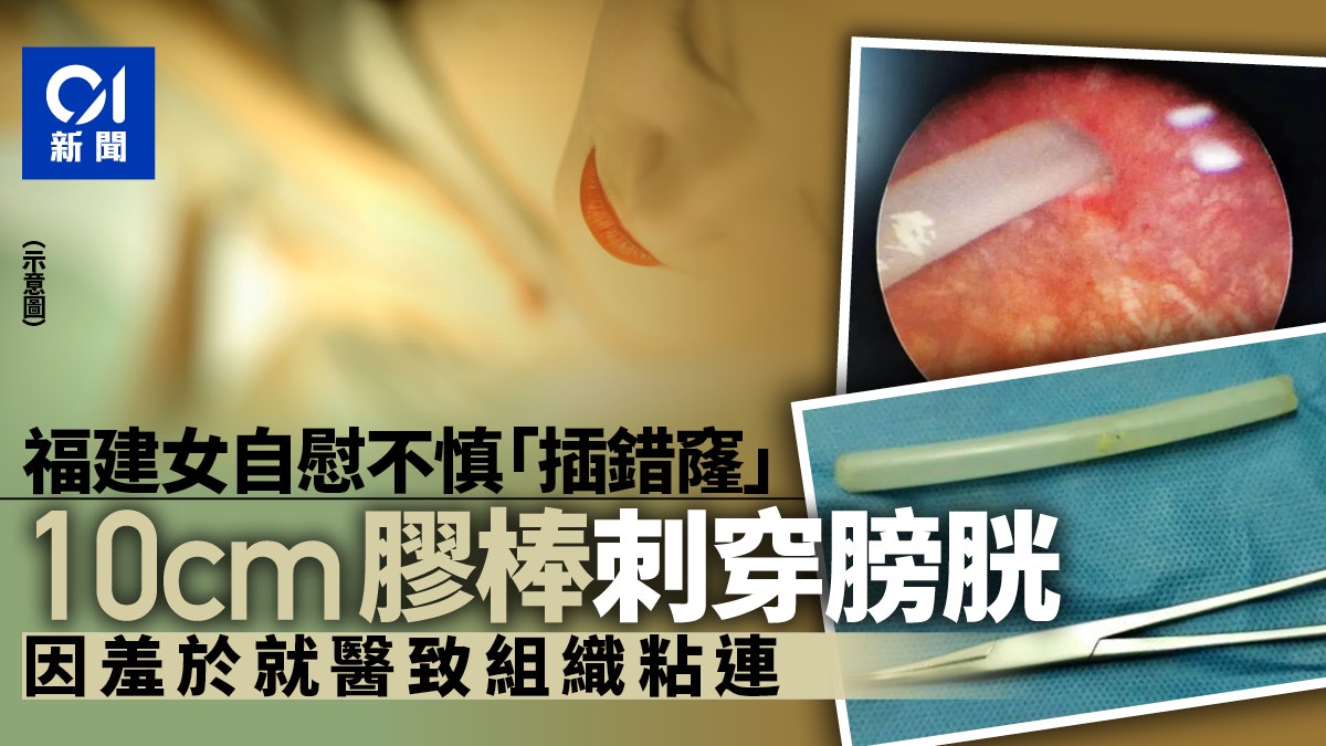 慎入 福建女自慰時 插錯窿 近10厘米膠棒尿道直入刺穿膀胱 慎入 福建女自慰時 插錯窿 近10厘米膠棒尿道直入刺穿膀胱