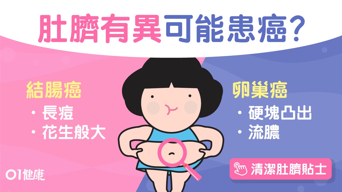 【癌症】肚臍突硬塊流濃竟是卵巢癌？40歲女肚臍長痘已結腸癌未期