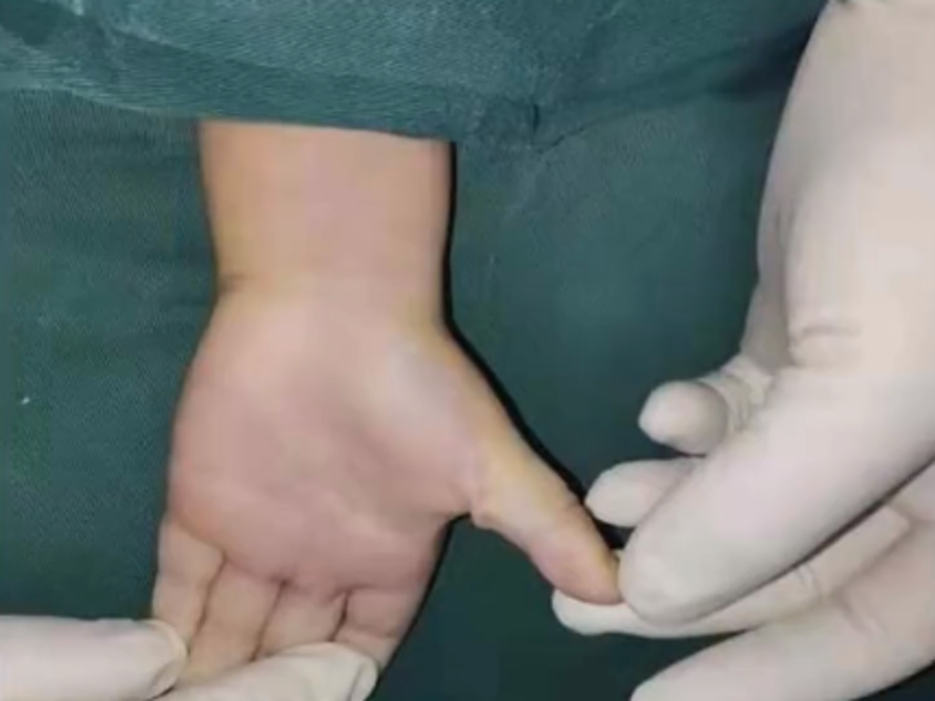 醫生檢查後，認為雯雯雙手的姆指均確診狹窄性腱鞘炎，俗稱玩手機電腦造成的「扳機指」，須接受手術改善手指的活動能力。（沸點影片截圖）