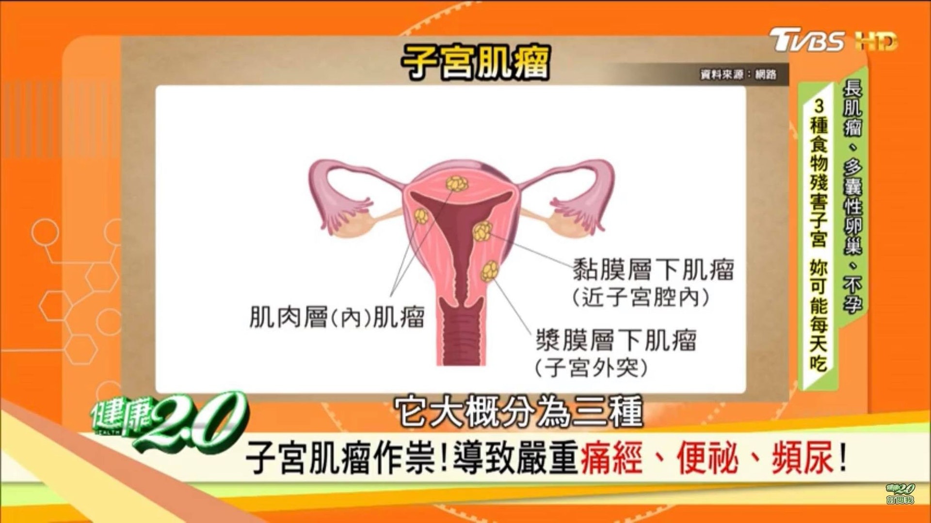 如果子宮肌瘤是單一粒,尤其速度長得很快的,如半年內增加一倍,惡性機會可達10%,最好3-6個月追蹤一次。(影片截圖) 如果子宮肌瘤是單一粒,尤其速度長得很快的,如半年內增加一倍,惡性機會可達10%,最好3-6個月追蹤一次。(影片截圖)
