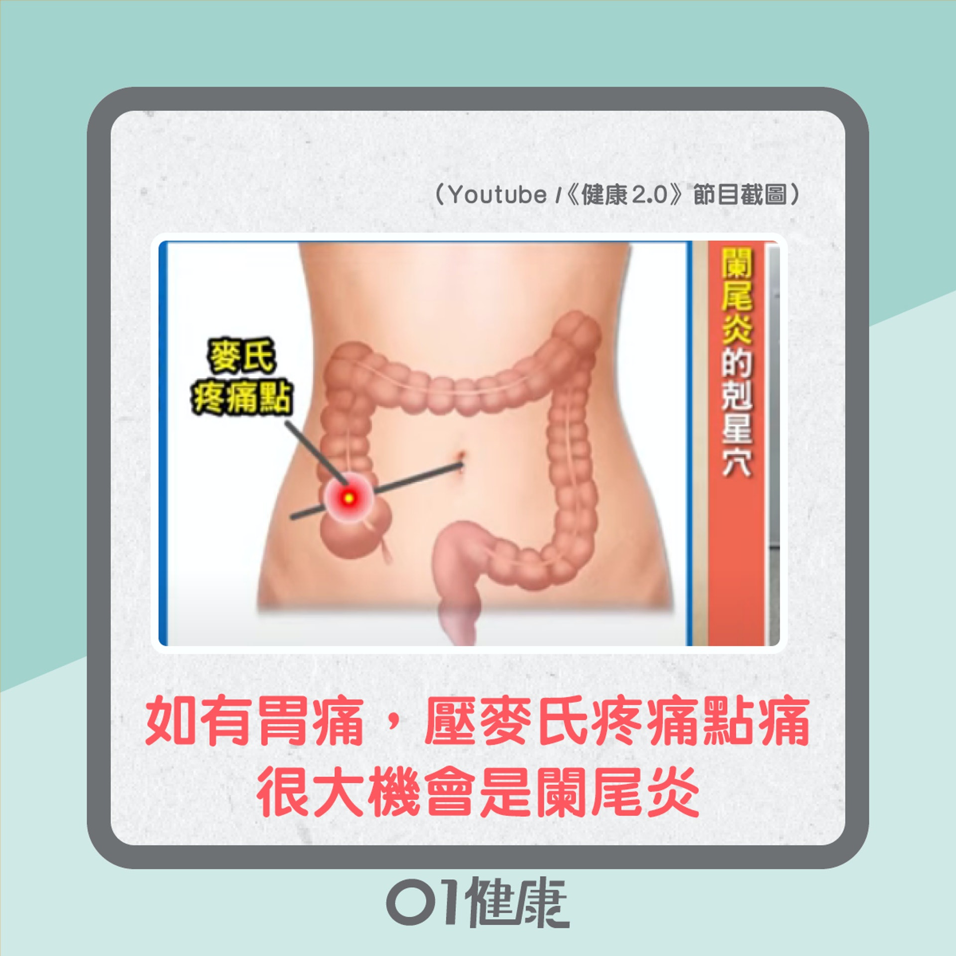 點知係闌尾炎?(01製圖) 點知係闌尾炎?(01製圖)