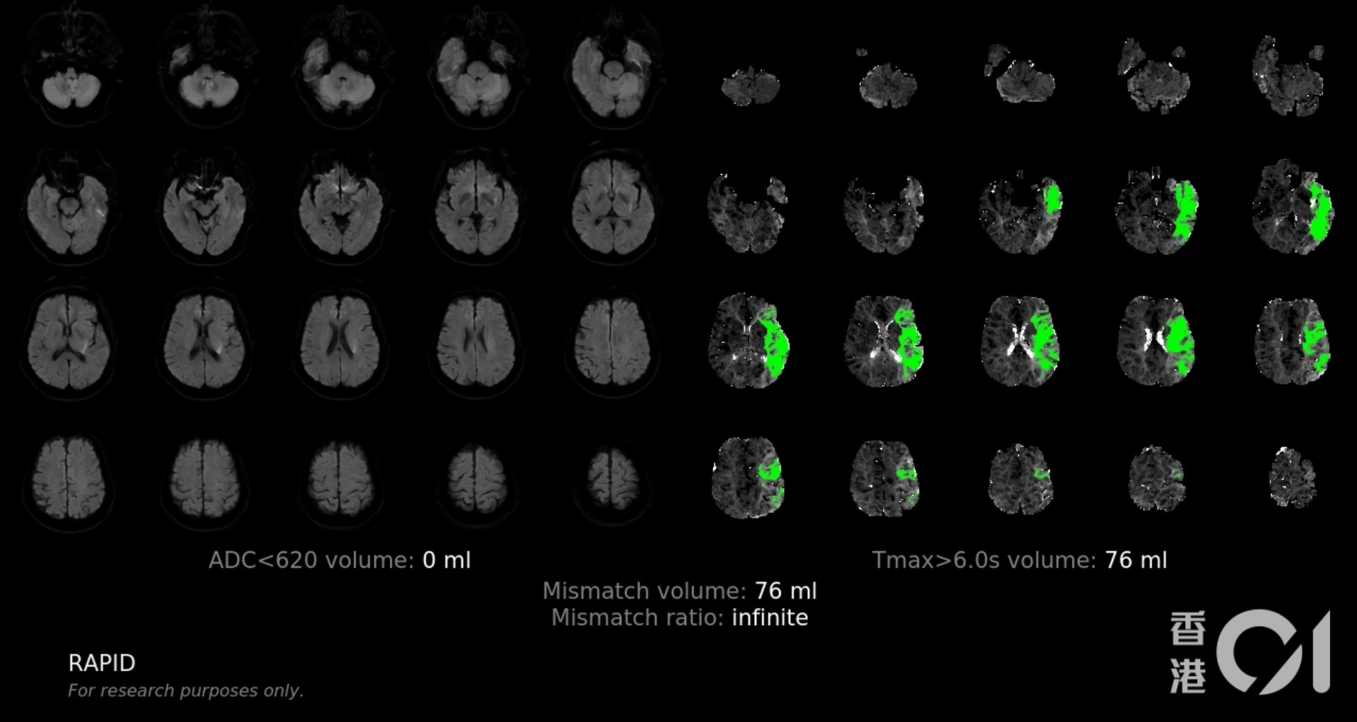 圖為人工智能系統的腦部圖像分析，綠色為低灌注的腦組織範圍（可拯救組織）。綠色範圍越大，術後改善病情的機會越大。（養和醫院提供）