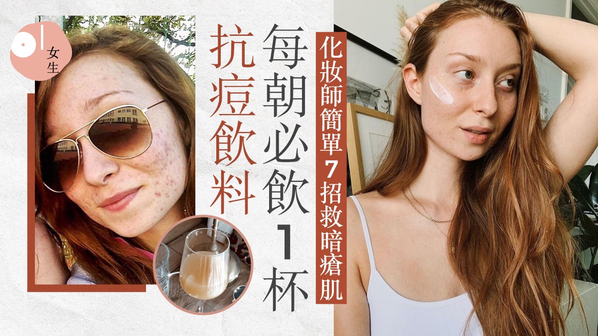 抗痘護膚|化妝師簡單7招救爛面 日飲3公升水不做Facial治好暗瘡 抗痘護膚|化妝師簡單7招救爛面 日飲3公升水不做Facial治好暗瘡