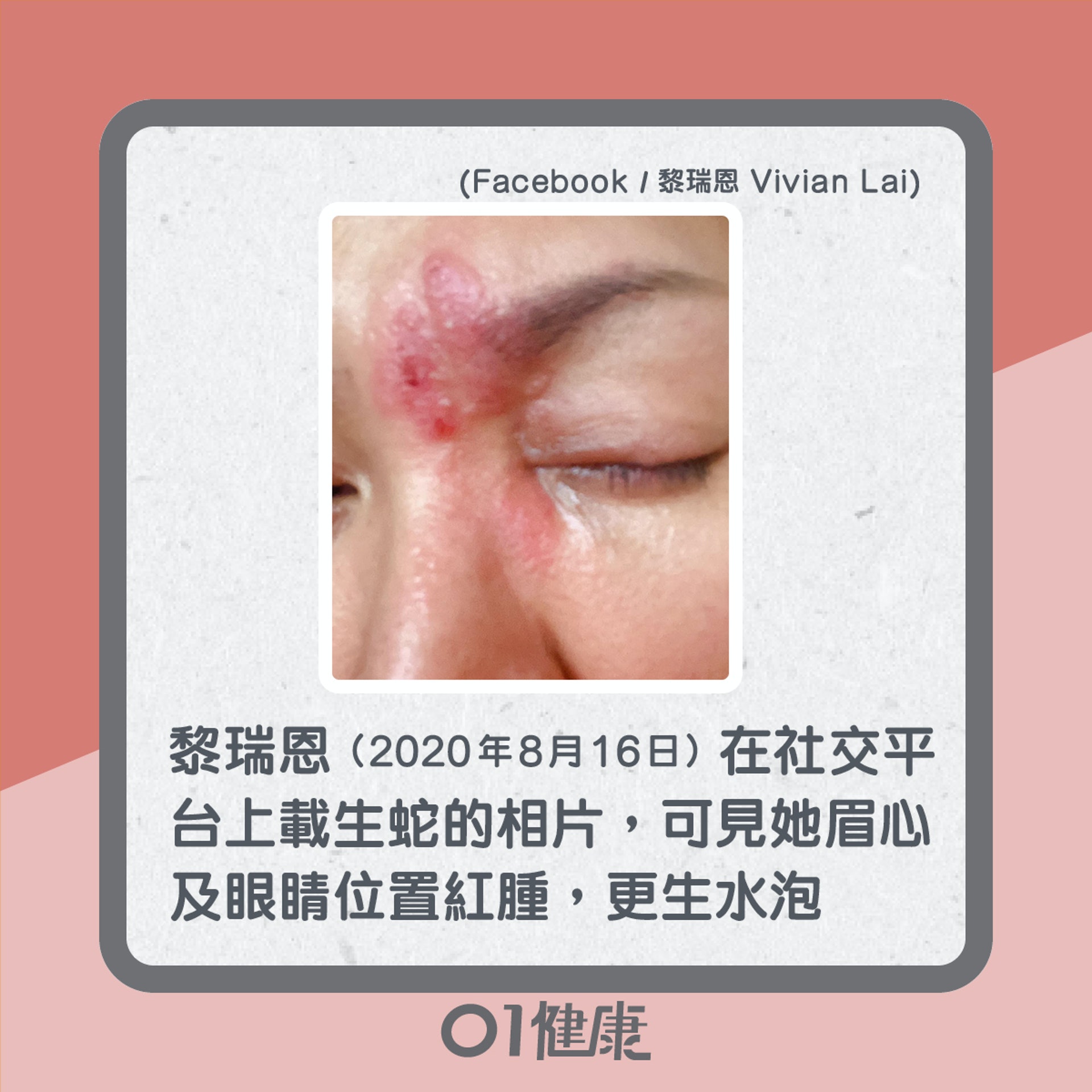 生蛇 劉佩玥自爆似火燒超級痛 10個須知把握黃金72小時小心留疤 香港01 健康