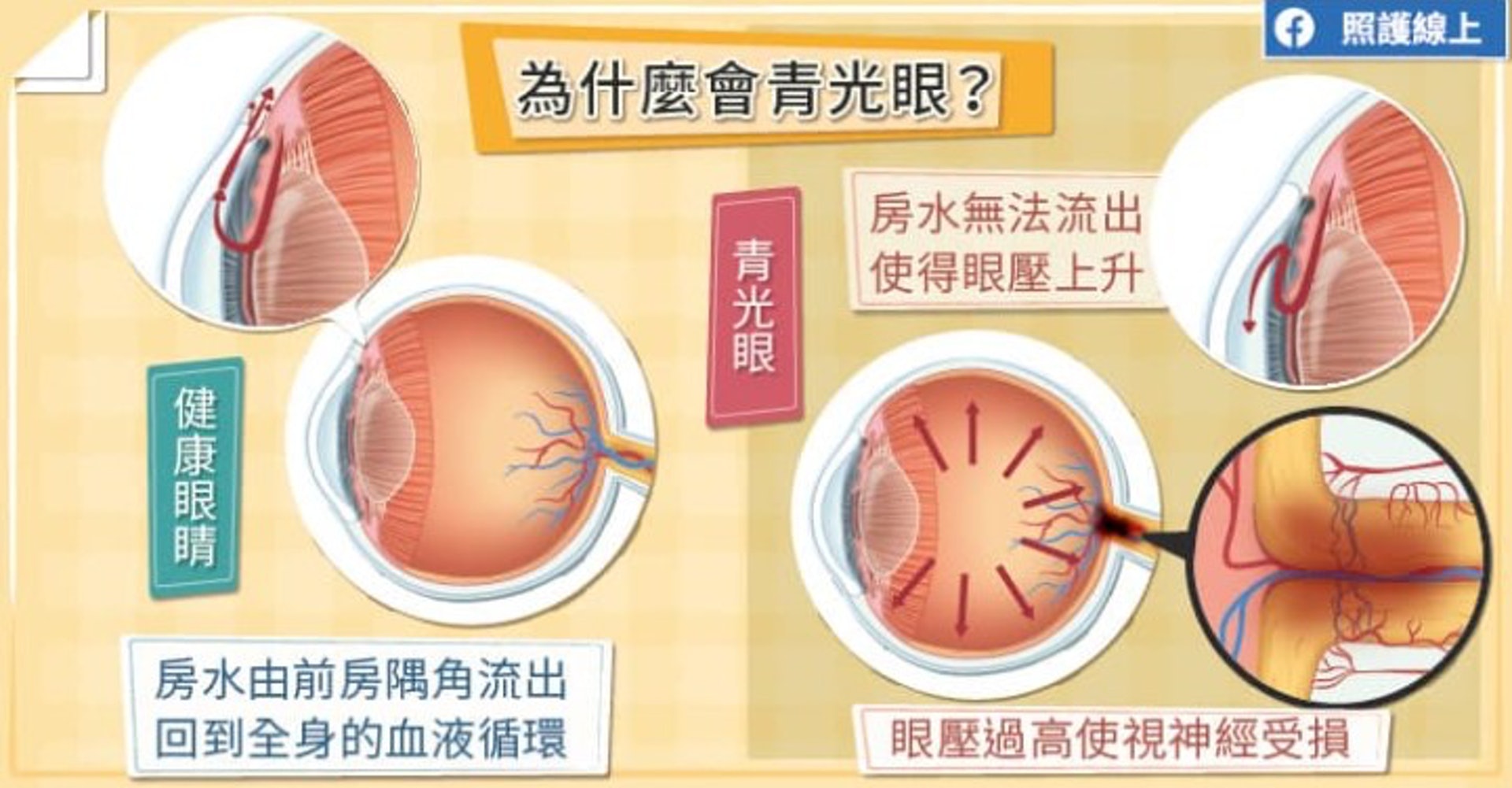 為什麽會青光眼?(照護線上授權使用) 為什麽會青光眼?(照護線上授權使用)