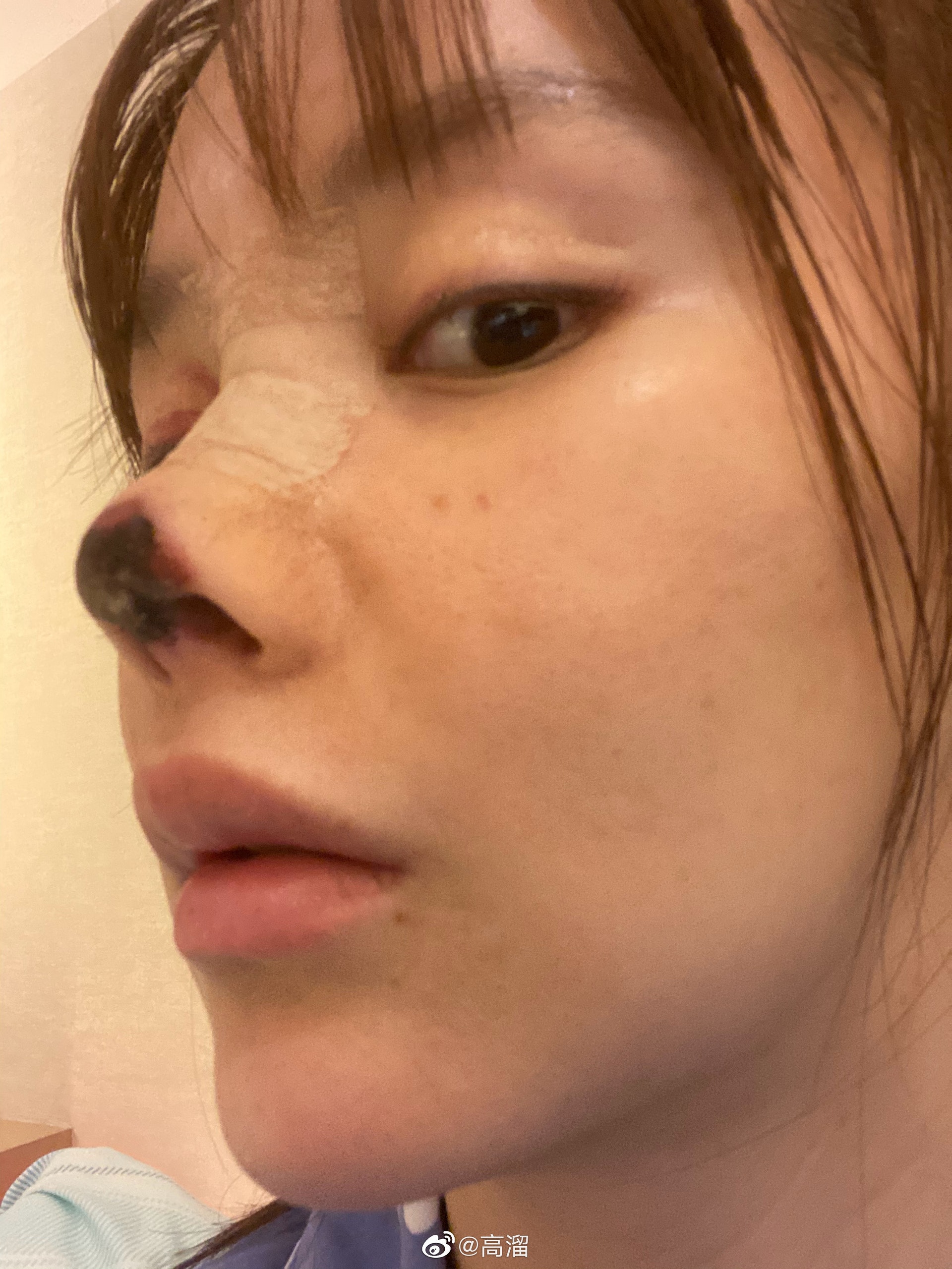 自爆整容失敗鼻壞死內地女星高溜 網民責罵我活該 非常難受 香港01 大國小事 自爆整容失敗鼻壞死內地女星高溜 網民責罵我活該 非常難受 香港01 大國小事