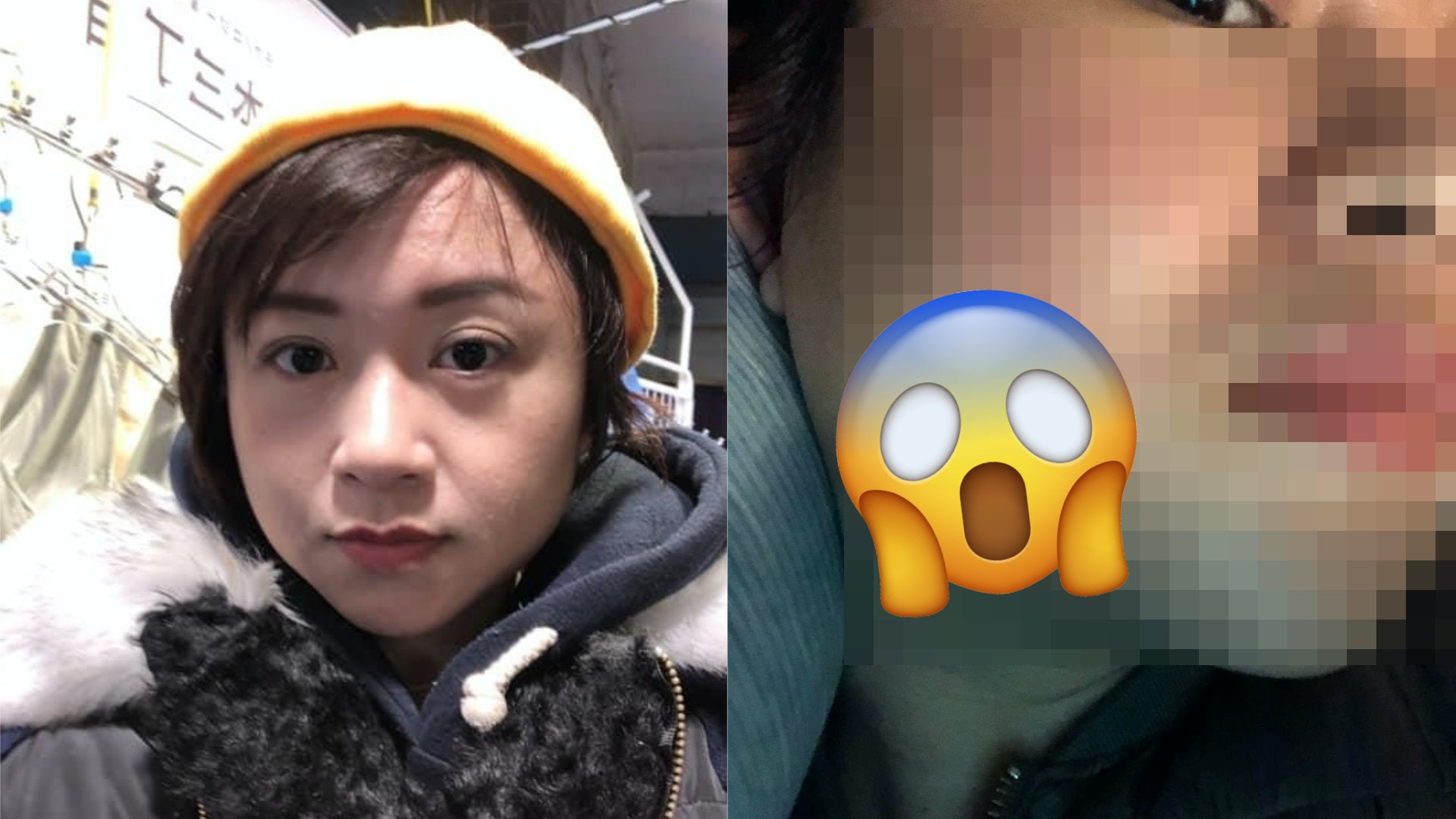 台灣美容院做facial竟變毀容 女子滿臉灼傷 貼圖證前後可怕對比 台灣美容院做facial竟變毀容 女子滿臉灼傷 貼圖證前後可怕對比
