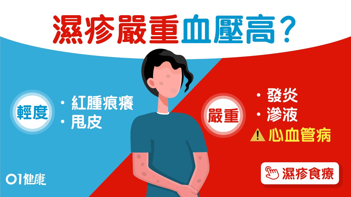 濕疹|皮膚發炎滲液嚴重可致糖尿心血管疾病!4不原則減免疫失調 濕疹|皮膚發炎滲液嚴重可致糖尿心血管疾病!4不原則減免疫失調