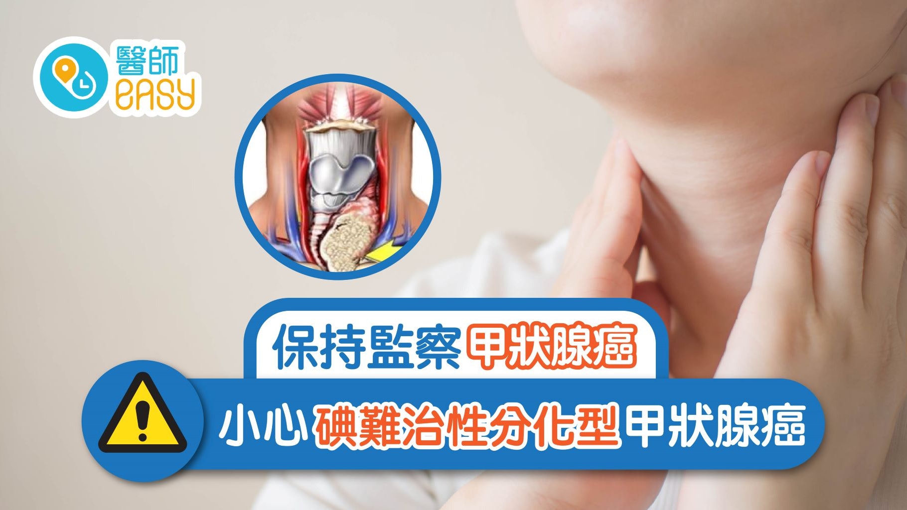 甲狀腺癌完成治療仍需監察 小心碘難治性分化型甲狀腺癌 甲狀腺癌完成治療仍需監察 小心碘難治性分化型甲狀腺癌