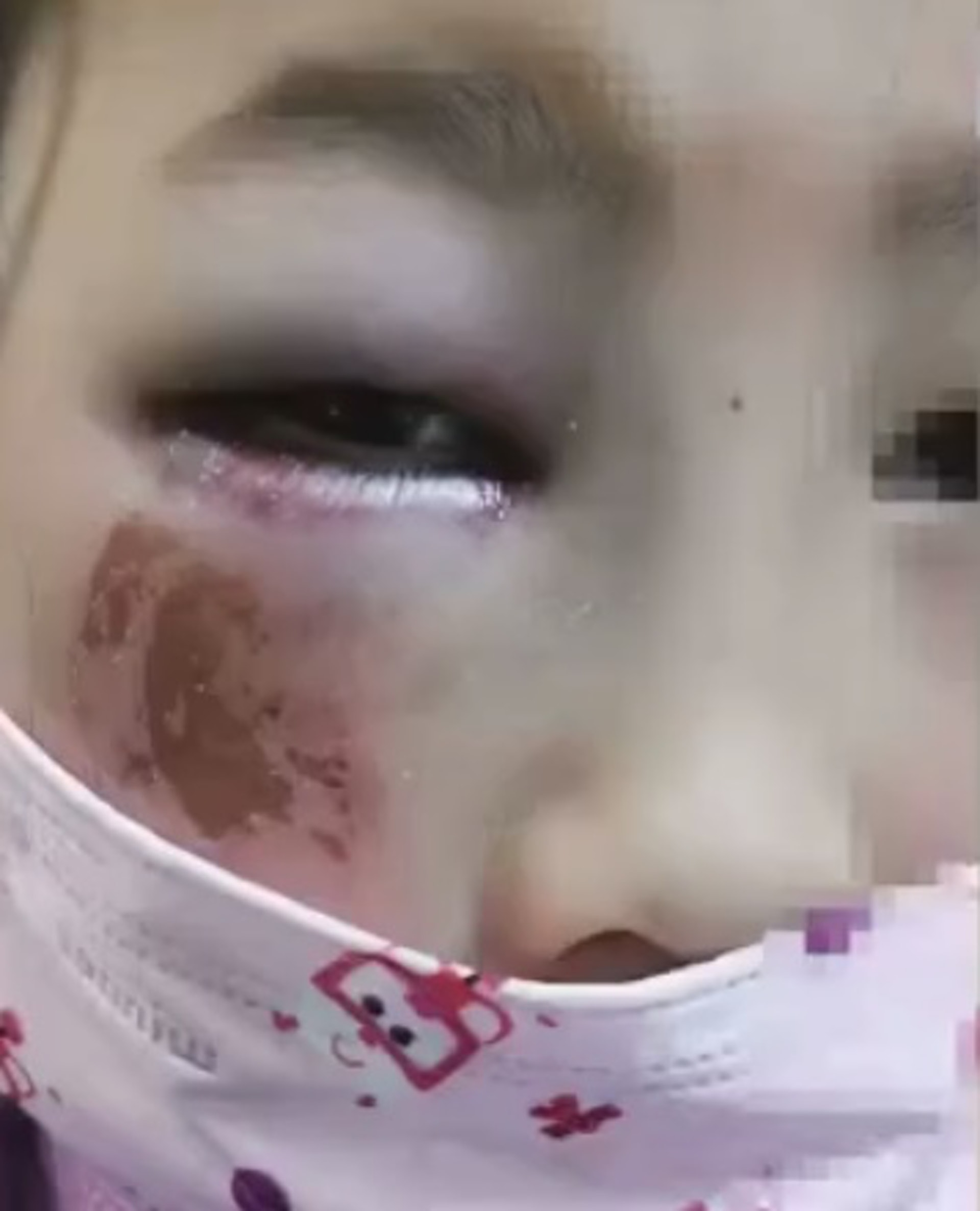 女童右眼和右臉嚴重受傷。（影片截圖）