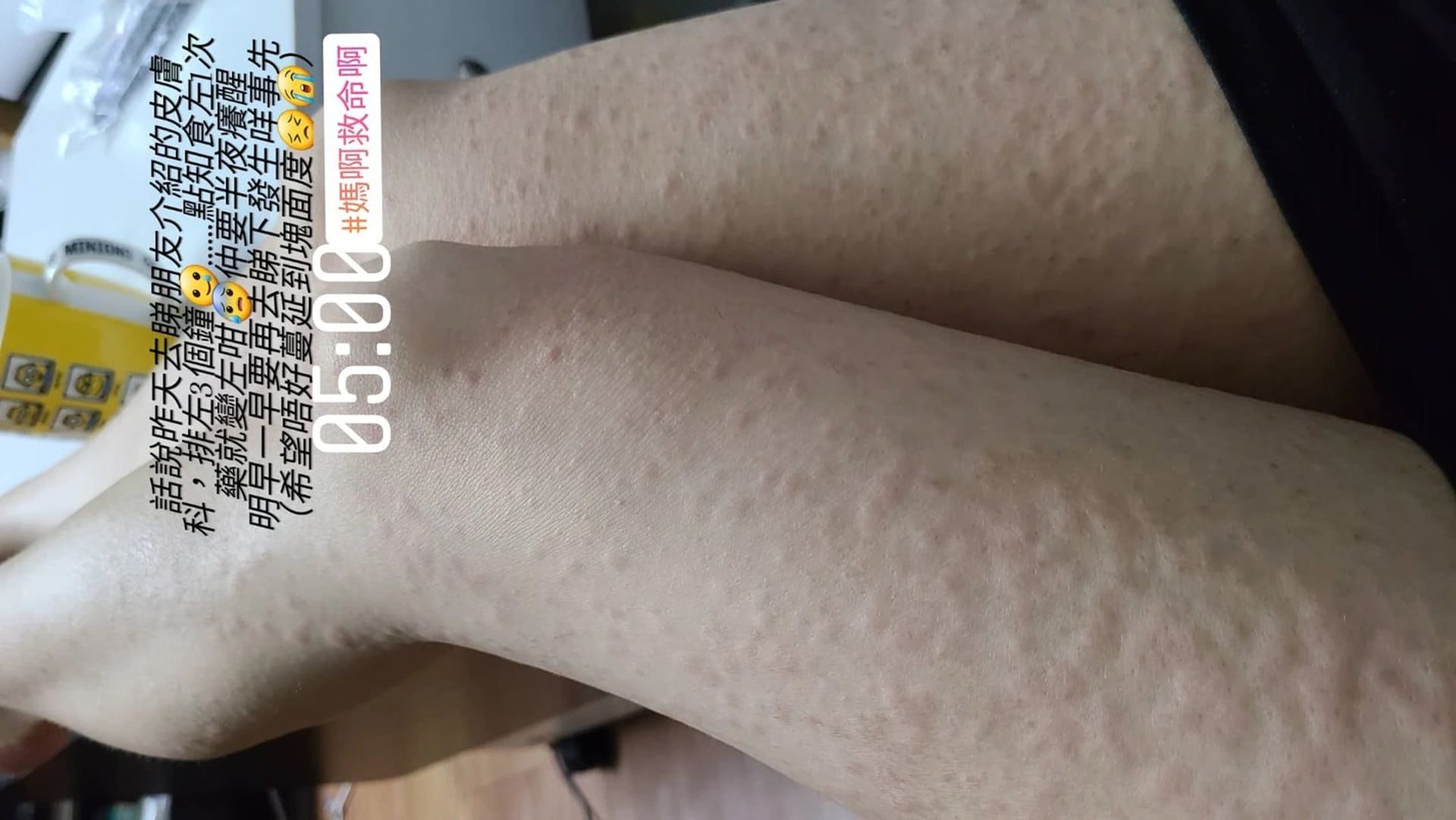 利穎怡一雙美腿佈滿風癩。(利穎怡IG) 利穎怡一雙美腿佈滿風癩。(利穎怡IG)