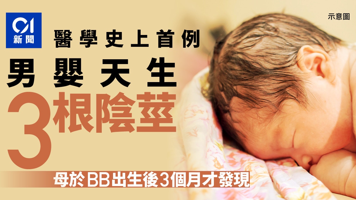 全球首例伊拉克男嬰天生有3根陰莖