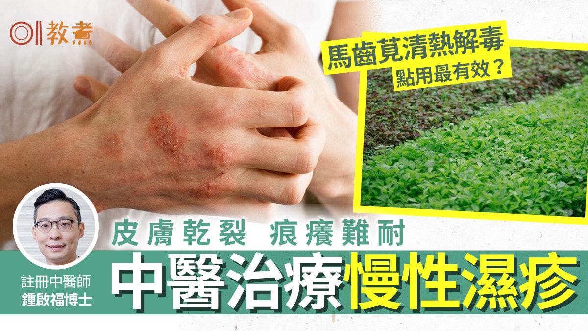 濕疹治療|急性慢性濕疹症狀不同 中醫推馬齒莧水涼血解毒減痕癢 濕疹治療|急性慢性濕疹症狀不同 中醫推馬齒莧水涼血解毒減痕癢