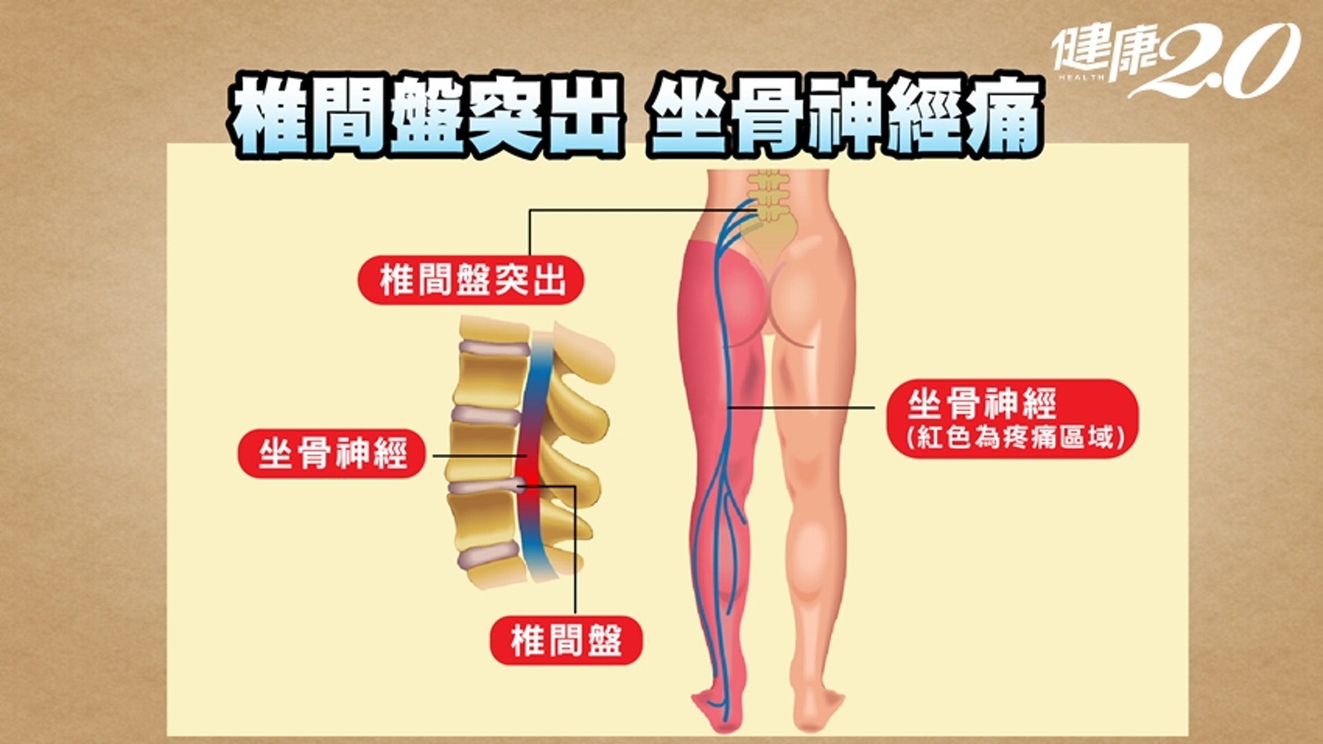 若是比較嚴重的疼痛則會壓迫到神經，就會從臀部開始往下，連腿部也會跟著痛，然後依照神經的分布產生不同的麻木感。（健康2.0授權使用）