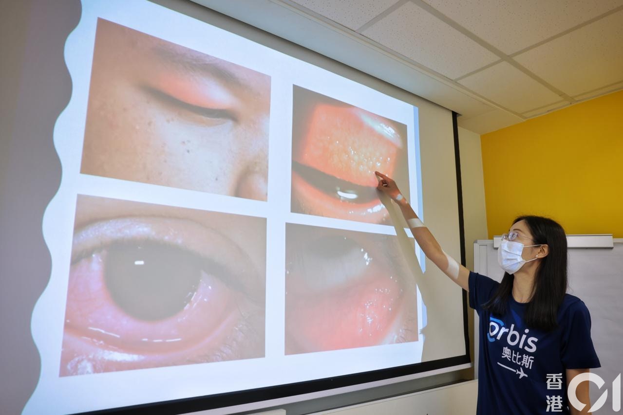 患者長期捽眼,嚴重可導致角膜受損、散光加深甚至永久損害視力。另外長期捽眼亦有機會將手中細菌帶入眼中,增加感染風險。(李澤彤攝)