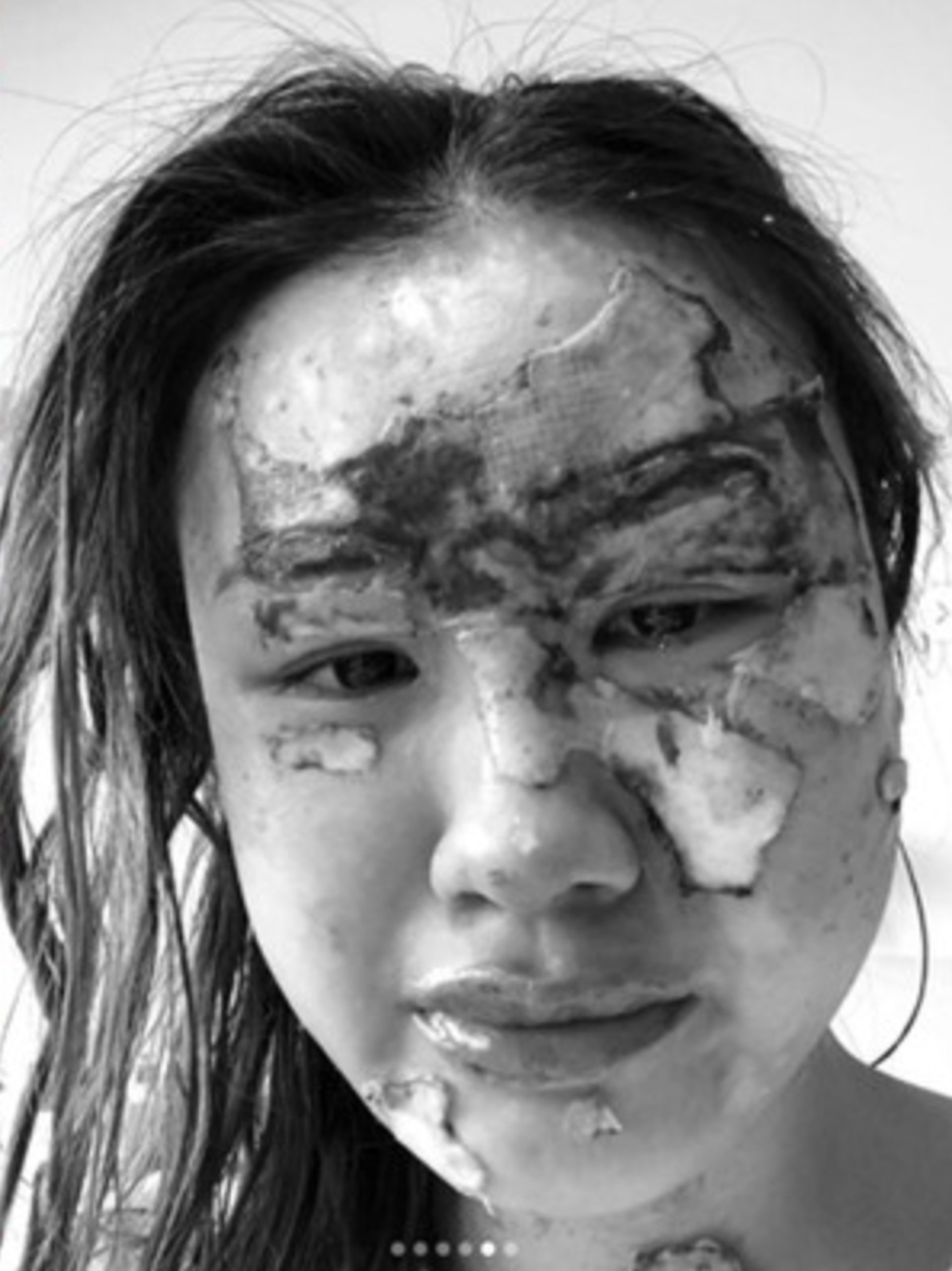 意外導致她臉部嚴重燒傷，大半張臉幾乎全毀。（IG@charlenechew）