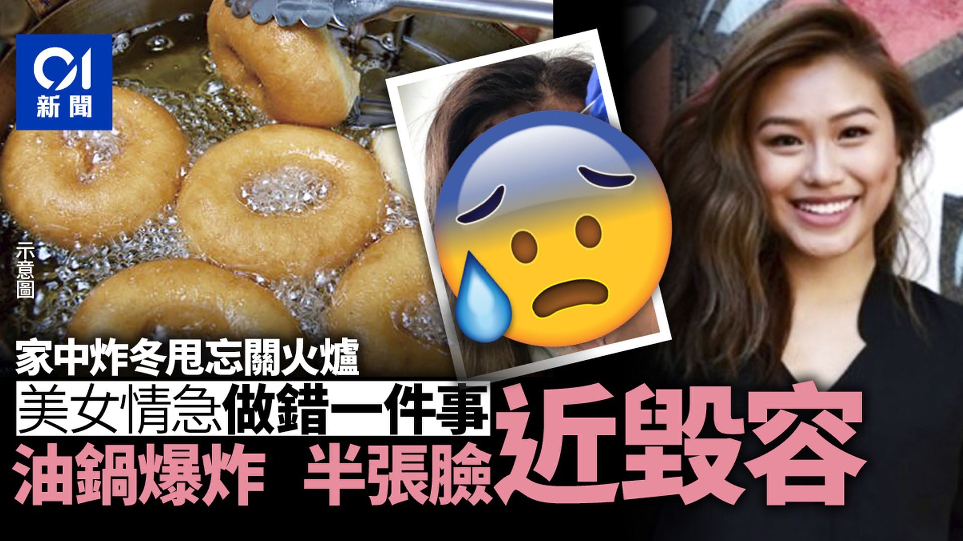【延伸閱讀】新加坡美女在家炸冬甩 一個錯誤動作致油鍋爆炸 半張臉幾乎全毀 【延伸閱讀】新加坡美女在家炸冬甩 一個錯誤動作致油鍋爆炸 半張臉幾乎全毀