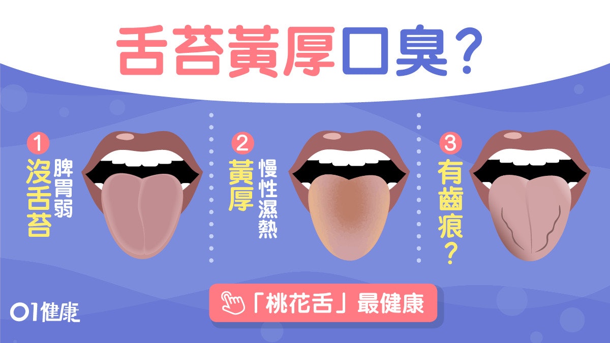 脷苔顏色 黃厚濕熱冇脷苔消化差5種脷苔反映脾胃怎樣最健康 脷苔顏色 黃厚濕熱冇脷苔消化差5種脷苔反映脾胃怎樣最健康