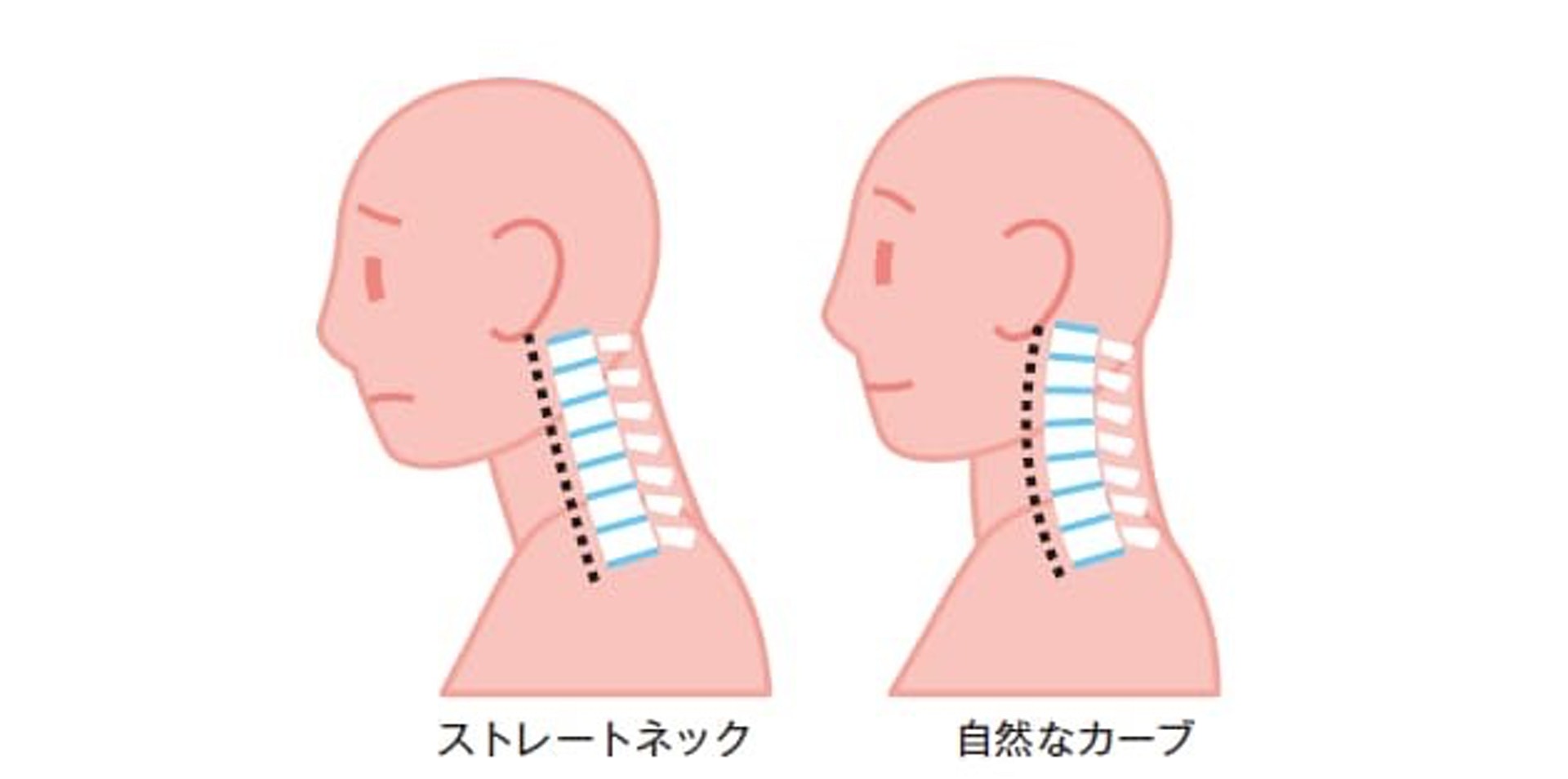 頸椎本是向前呈微微彎曲的狀態，支撐着上方的頭部（圖右），但假如長期駝背看電腦，就會導致頸椎錯位變成「直頸」（圖左）。（NIKKEI STYLE）